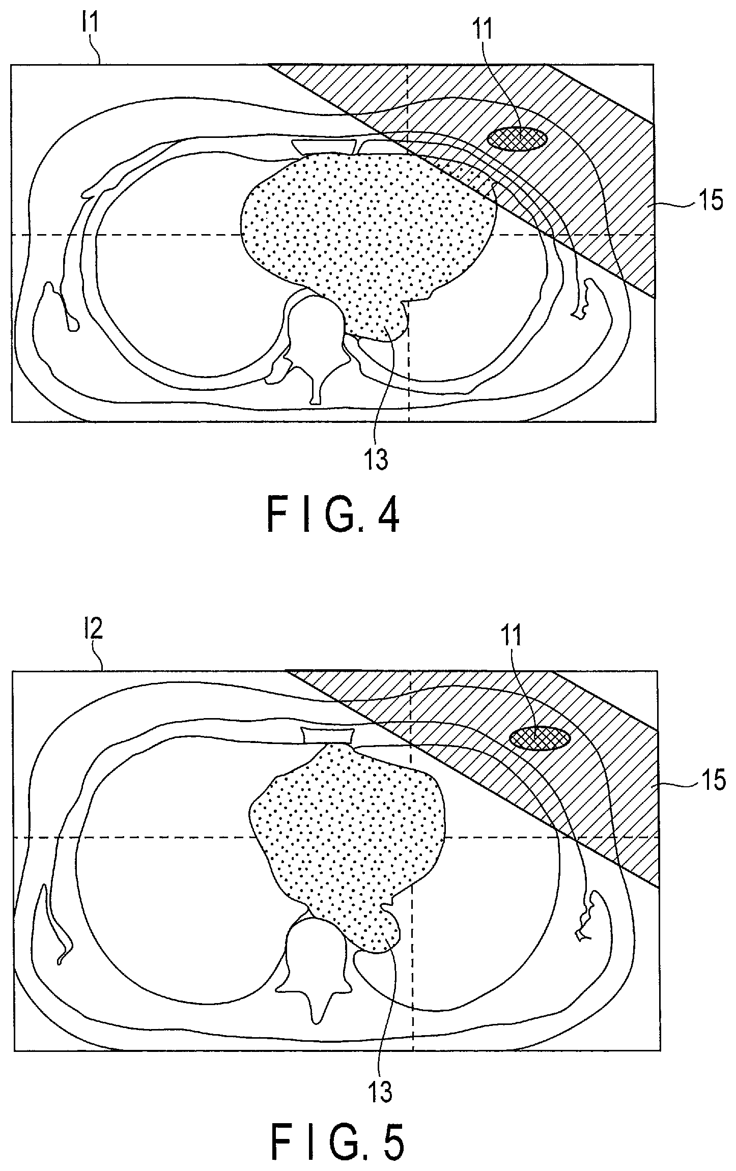 Patent US12097387 Figure 4 – Radiation treatment planning apparatus and radiation treatment apparatus