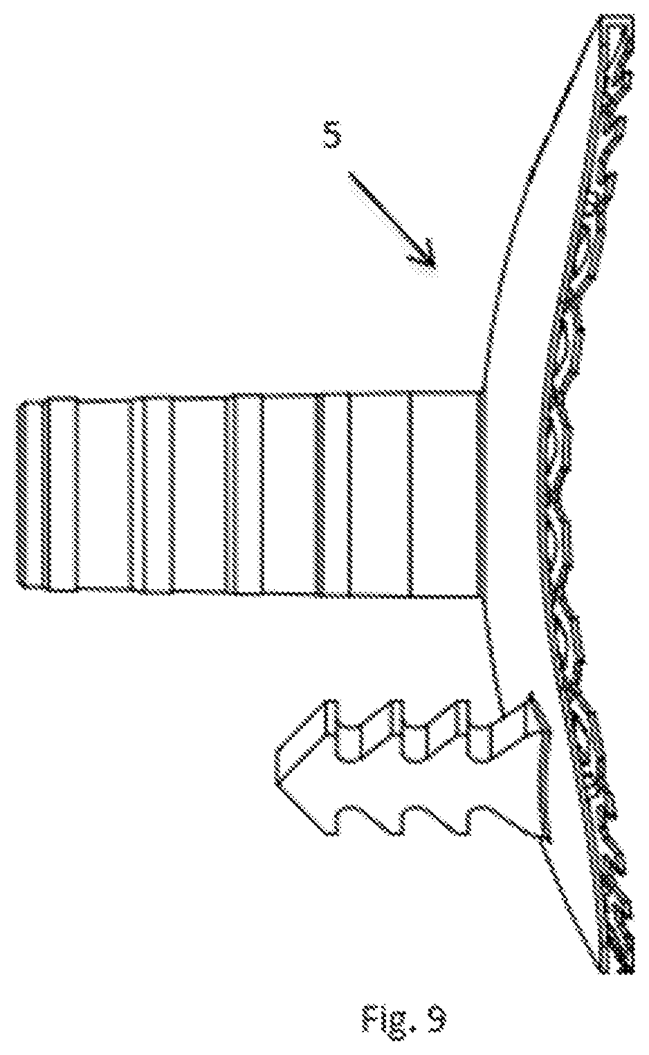 Patent US12097646 Figure 9 – Method for manufacturing an articular prosthesis implant using a ceramic imprint