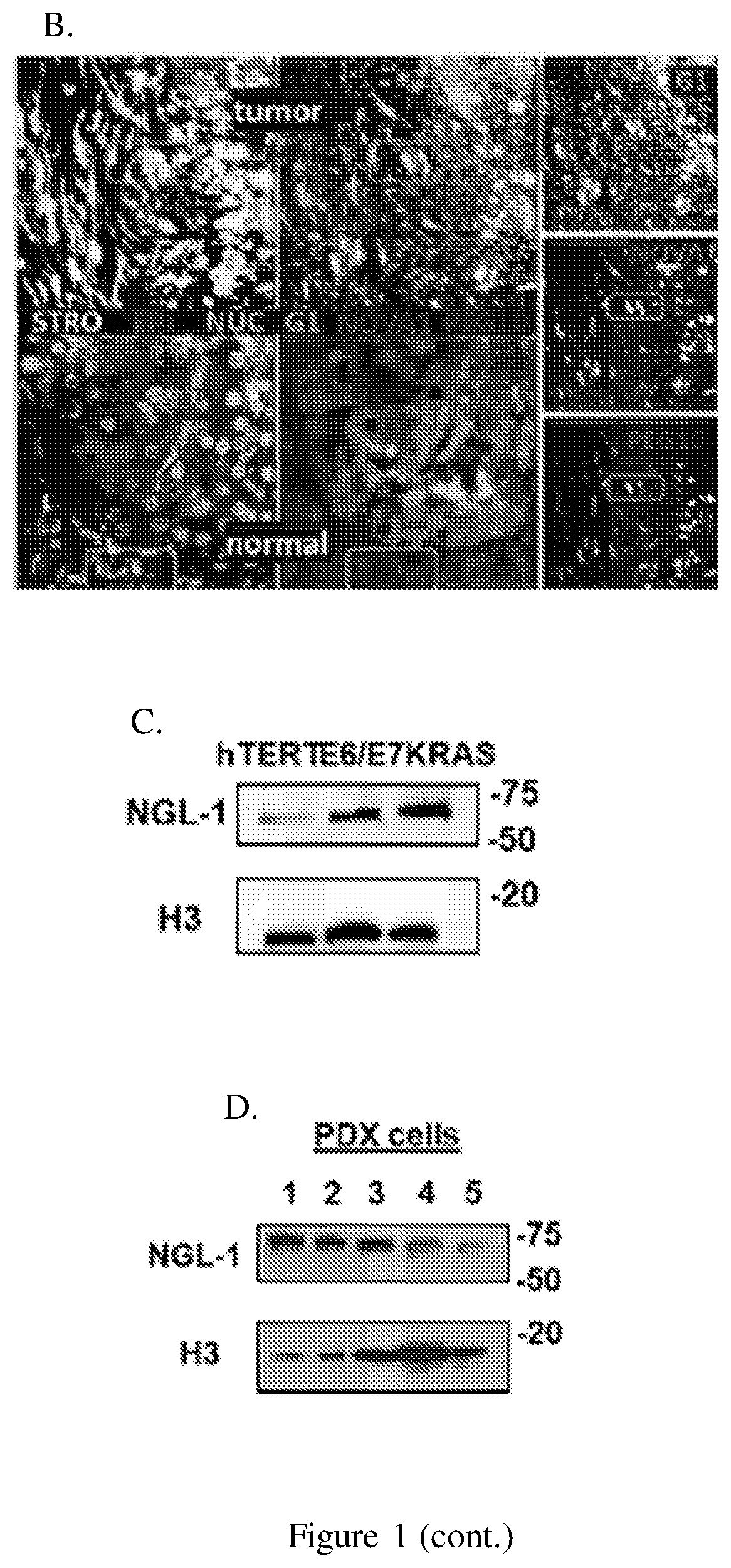 Patent US12098193 Figure 2 – Netrin G1 as a biomarker for enhancing tumor treatment efficacy