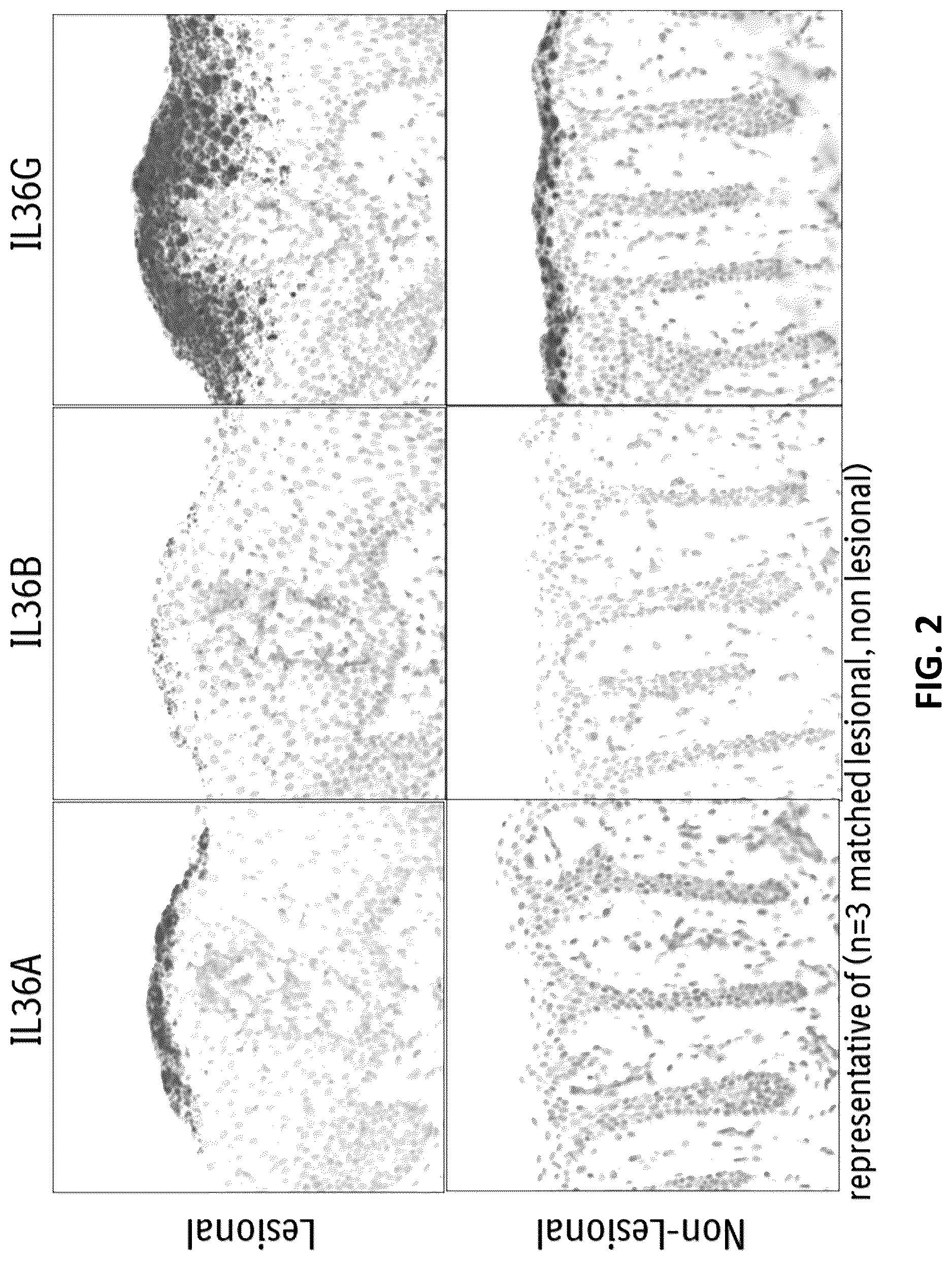 Patent US12098207 Figure 2 – Anti-IL-36R antibodies for the treatment of pyoderma gangrenosum