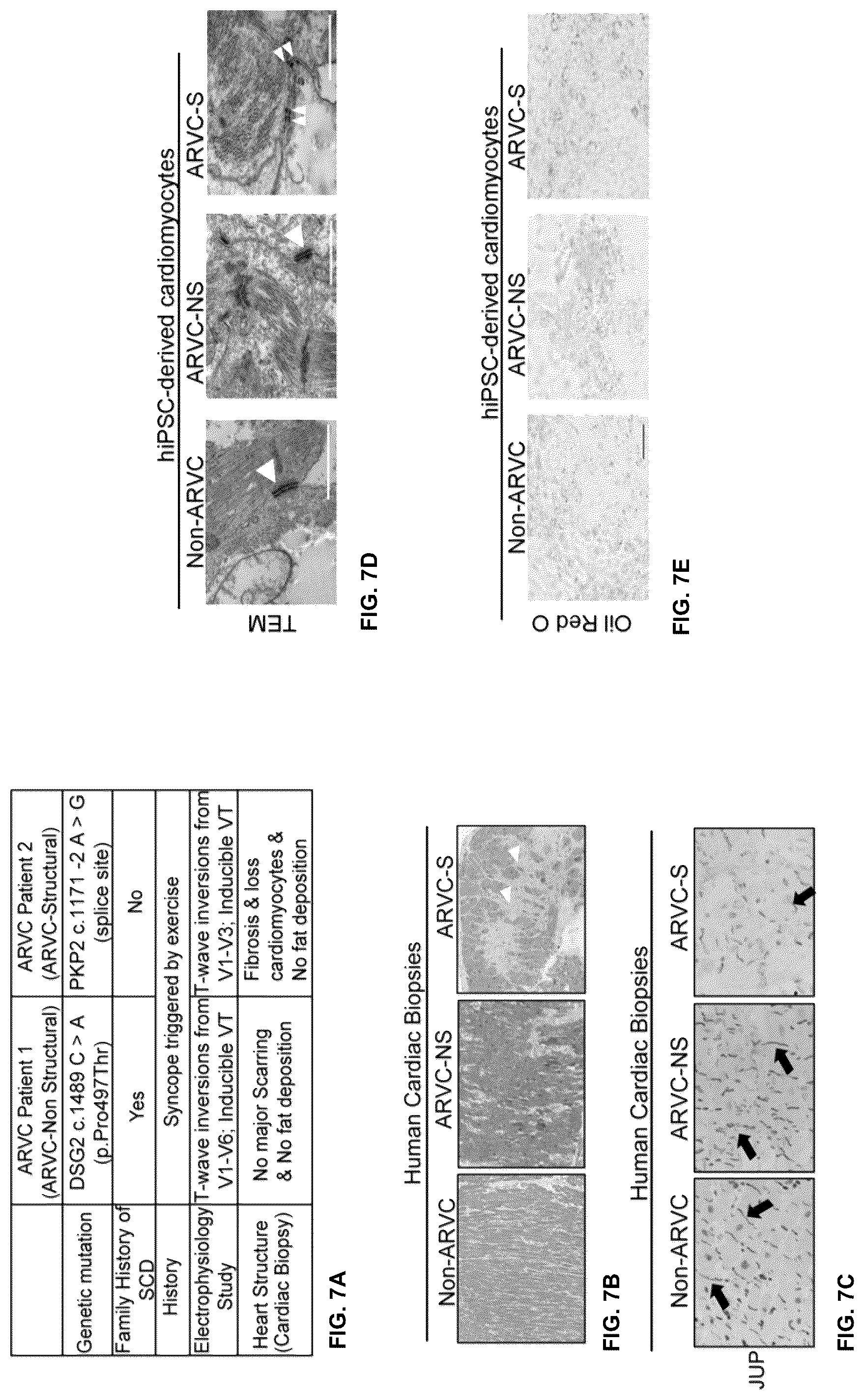 Patent US12098385 Figure 12 – Gene therapy strategy to restore cardiac electrical and structural function in arrhythmogenic right ventricular cardiomyopathy