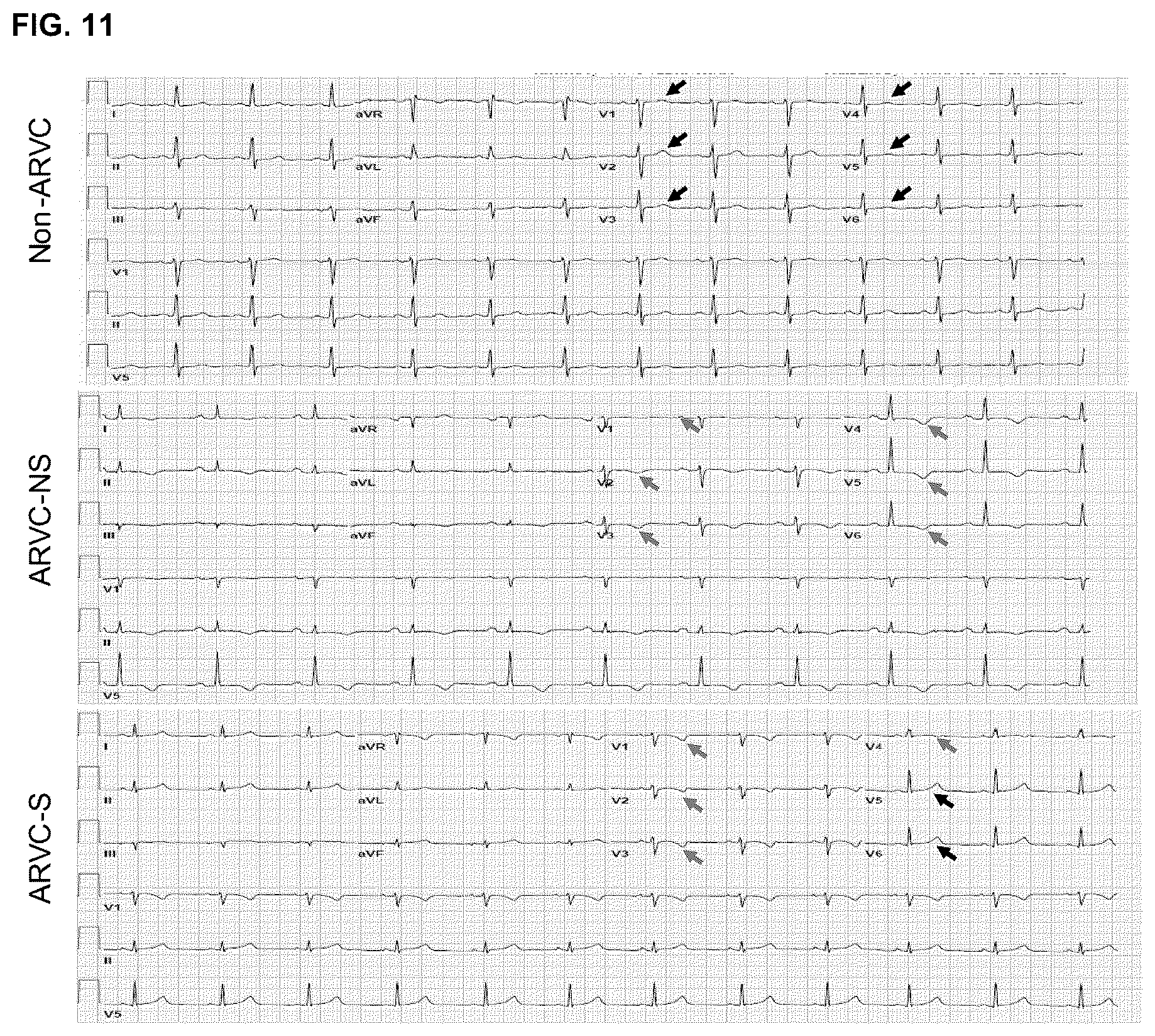 Patent US12098385 Figure 16 – Gene therapy strategy to restore cardiac electrical and structural function in arrhythmogenic right ventricular cardiomyopathy