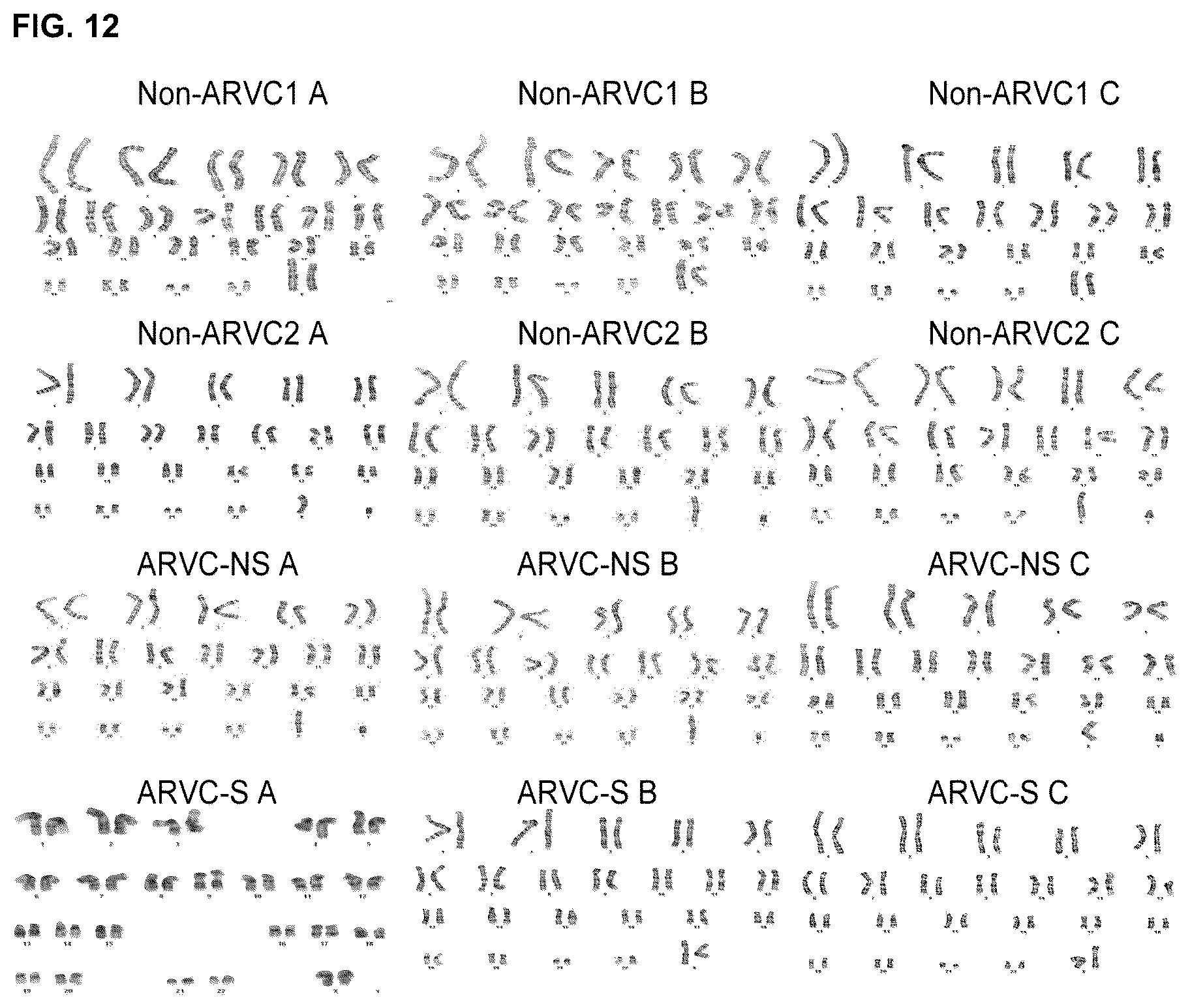 Patent US12098385 Figure 17 – Gene therapy strategy to restore cardiac electrical and structural function in arrhythmogenic right ventricular cardiomyopathy
