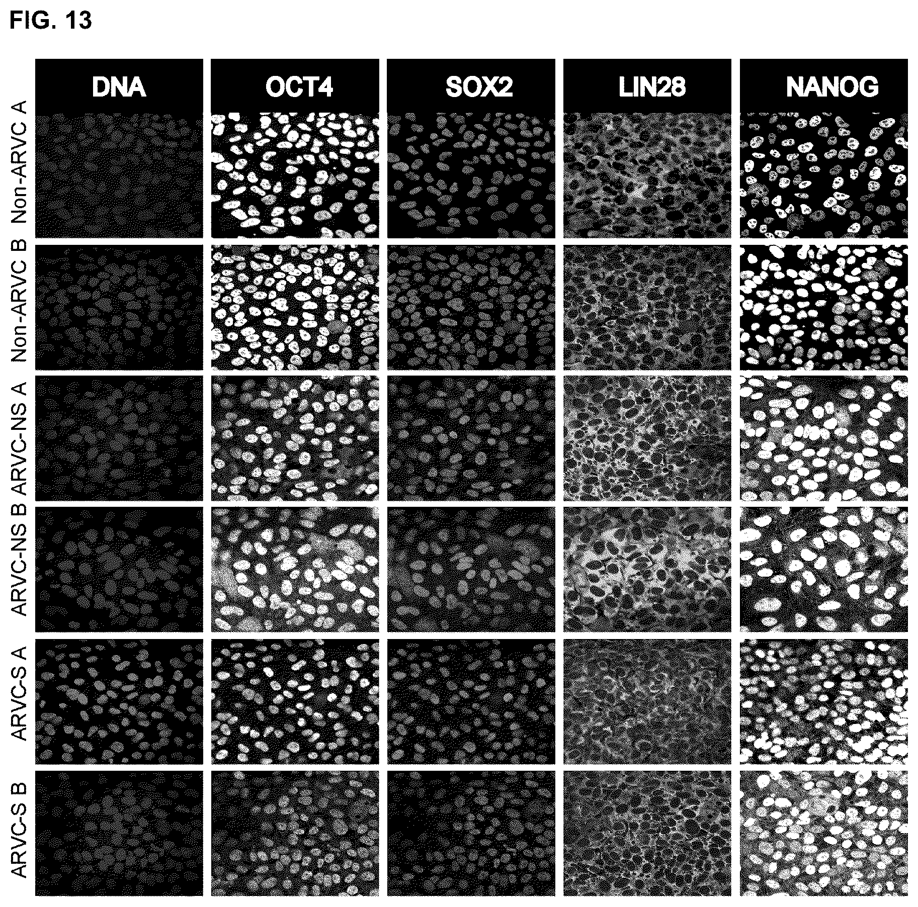 Patent US12098385 Figure 18 – Gene therapy strategy to restore cardiac electrical and structural function in arrhythmogenic right ventricular cardiomyopathy