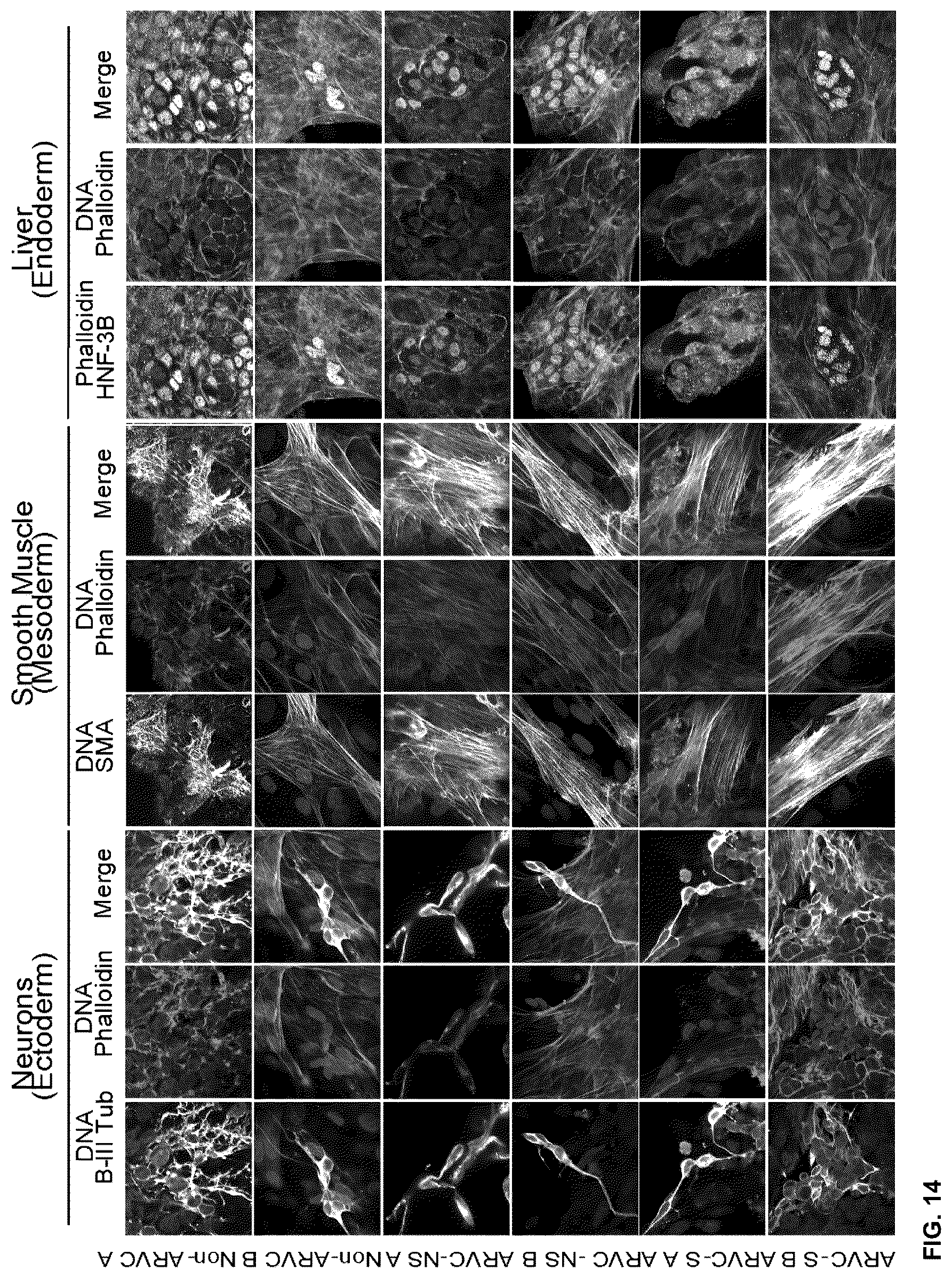 Patent US12098385 Figure 19 – Gene therapy strategy to restore cardiac electrical and structural function in arrhythmogenic right ventricular cardiomyopathy