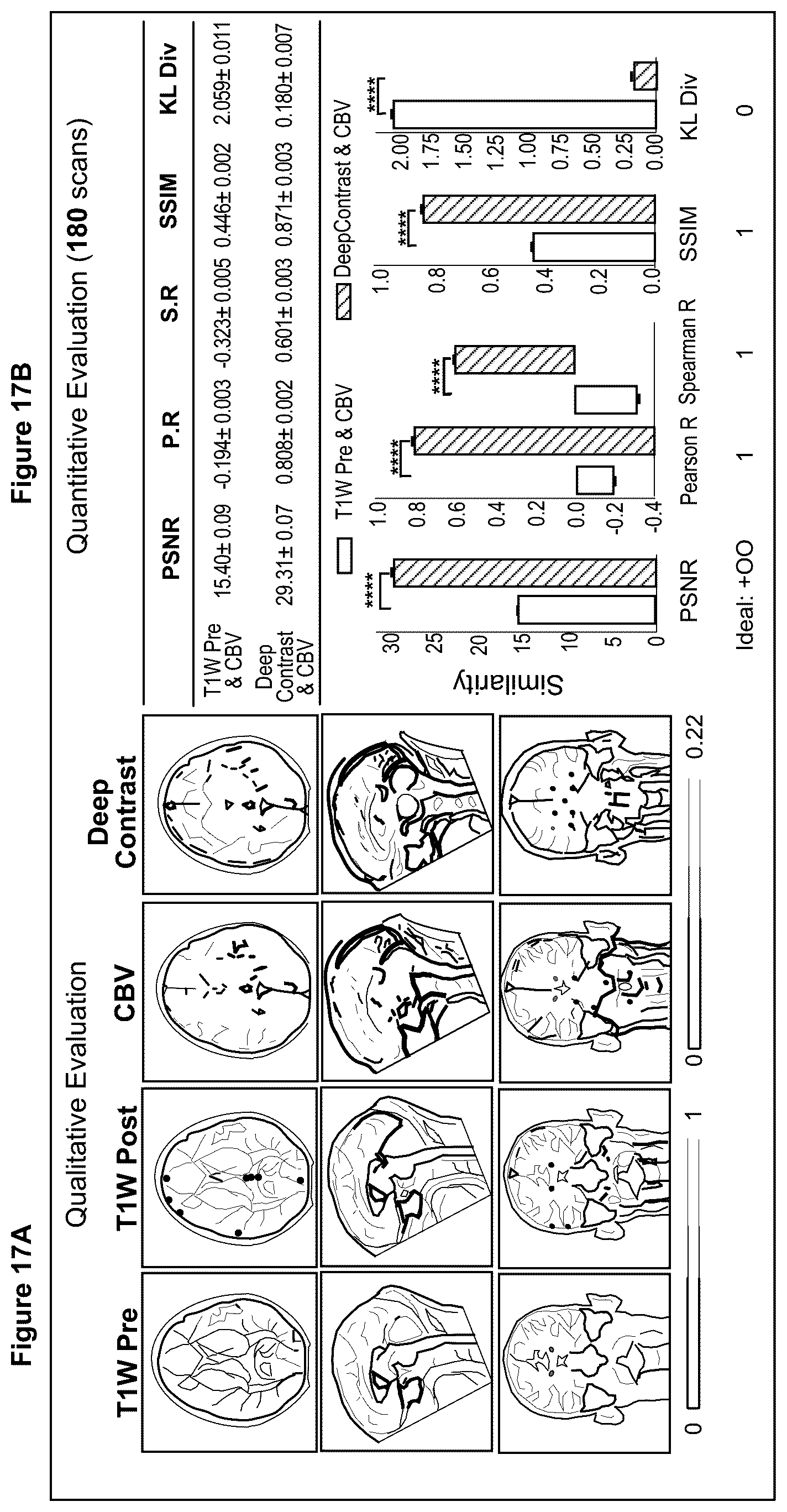 Patent US12100121 Figure 17 – System, method and computer-accessible medium for detecting structural disorder(s) using magnetic resonance imaging