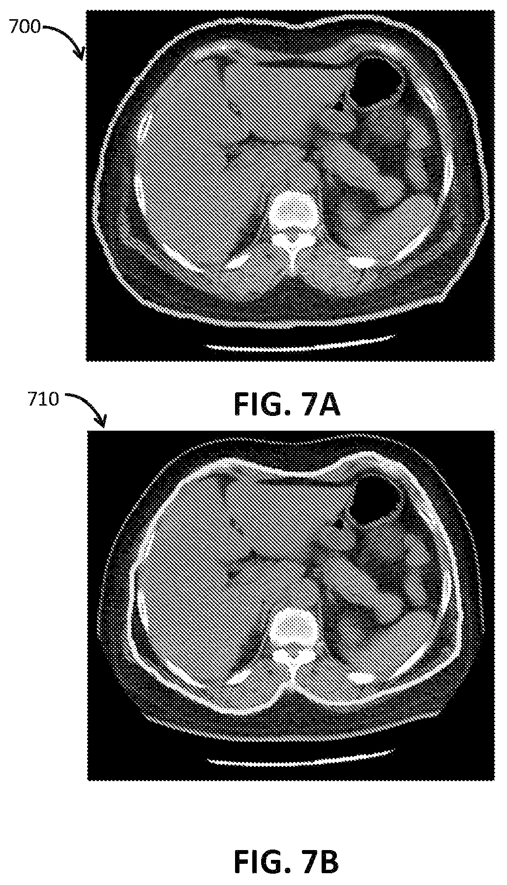 Patent US12100161 Figure 7 – Organ segmentation method and system