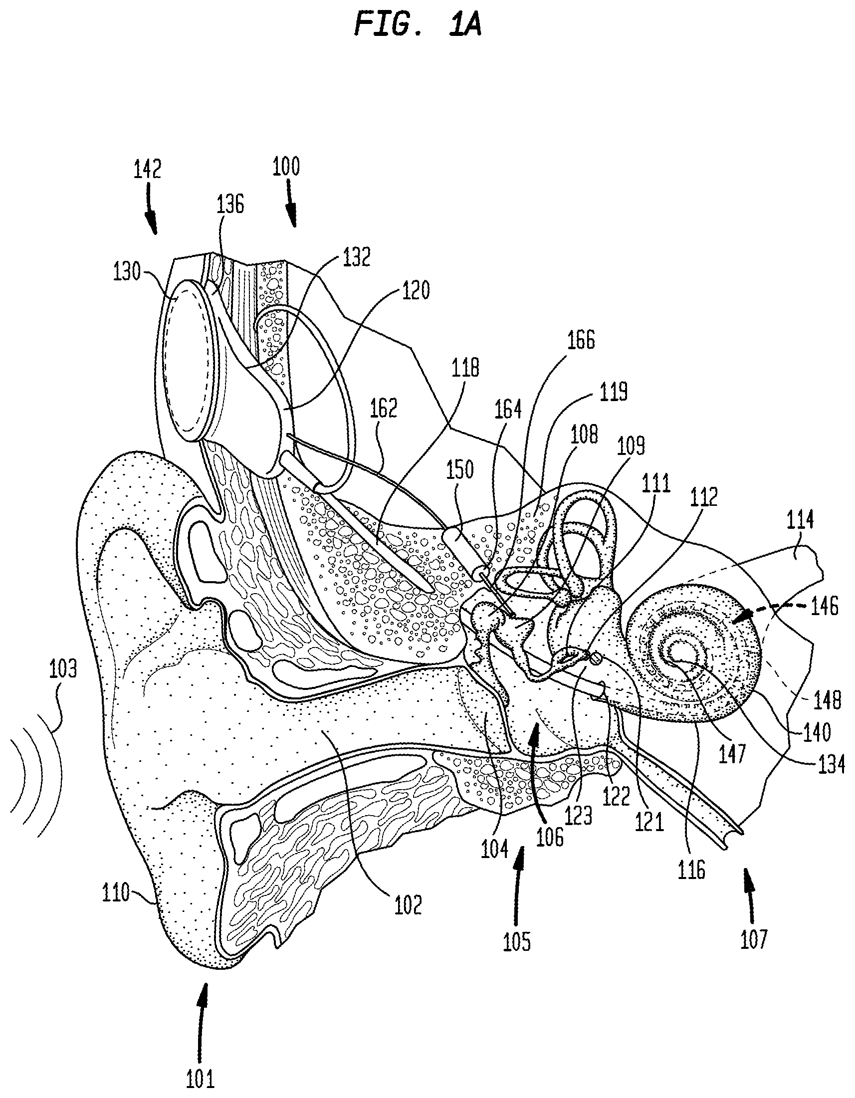 Patent US12101602 Figure 1 – Implantable sound sensors with non-uniform diaphragms