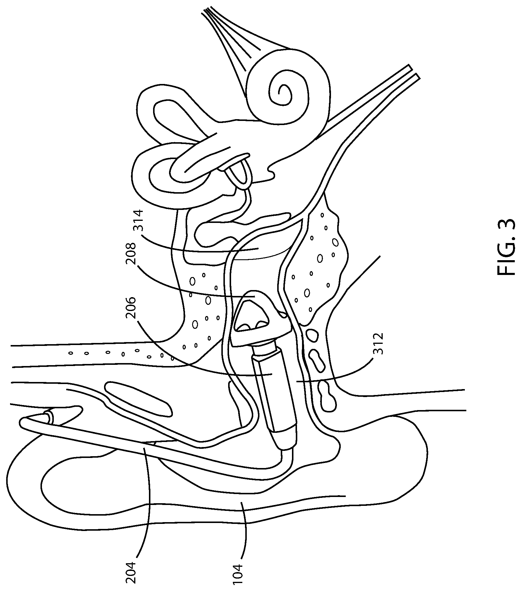 Patent US12101604 Figure 3 – Systems, devices and methods for fitting hearing assistance devices