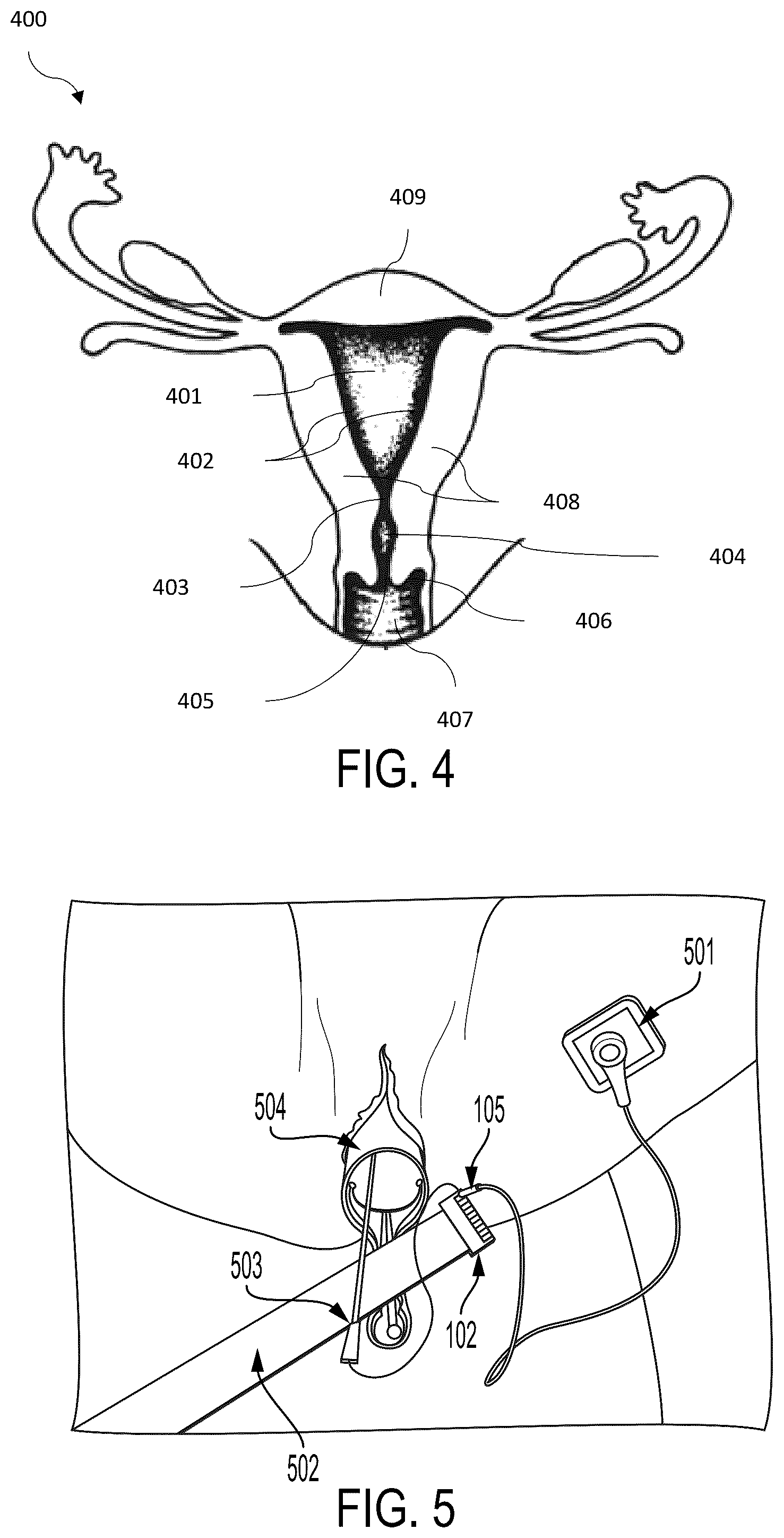 Patent US12102303 Figure 3 – Method and apparatus for direct in-vivo, electrical and chemical monitoring and stimulation of the endometrial cavity