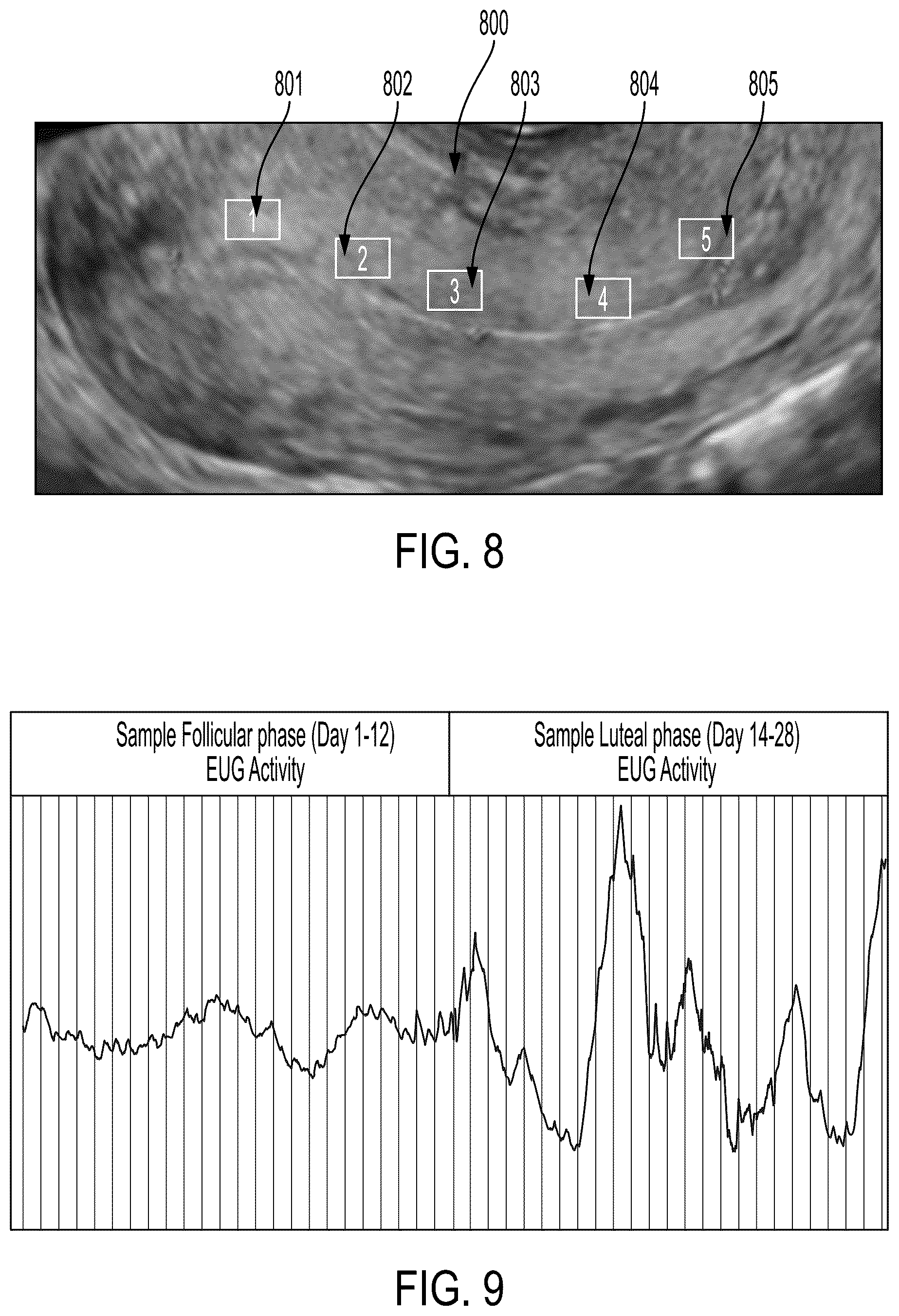Patent US12102303 Figure 5 – Method and apparatus for direct in-vivo, electrical and chemical monitoring and stimulation of the endometrial cavity