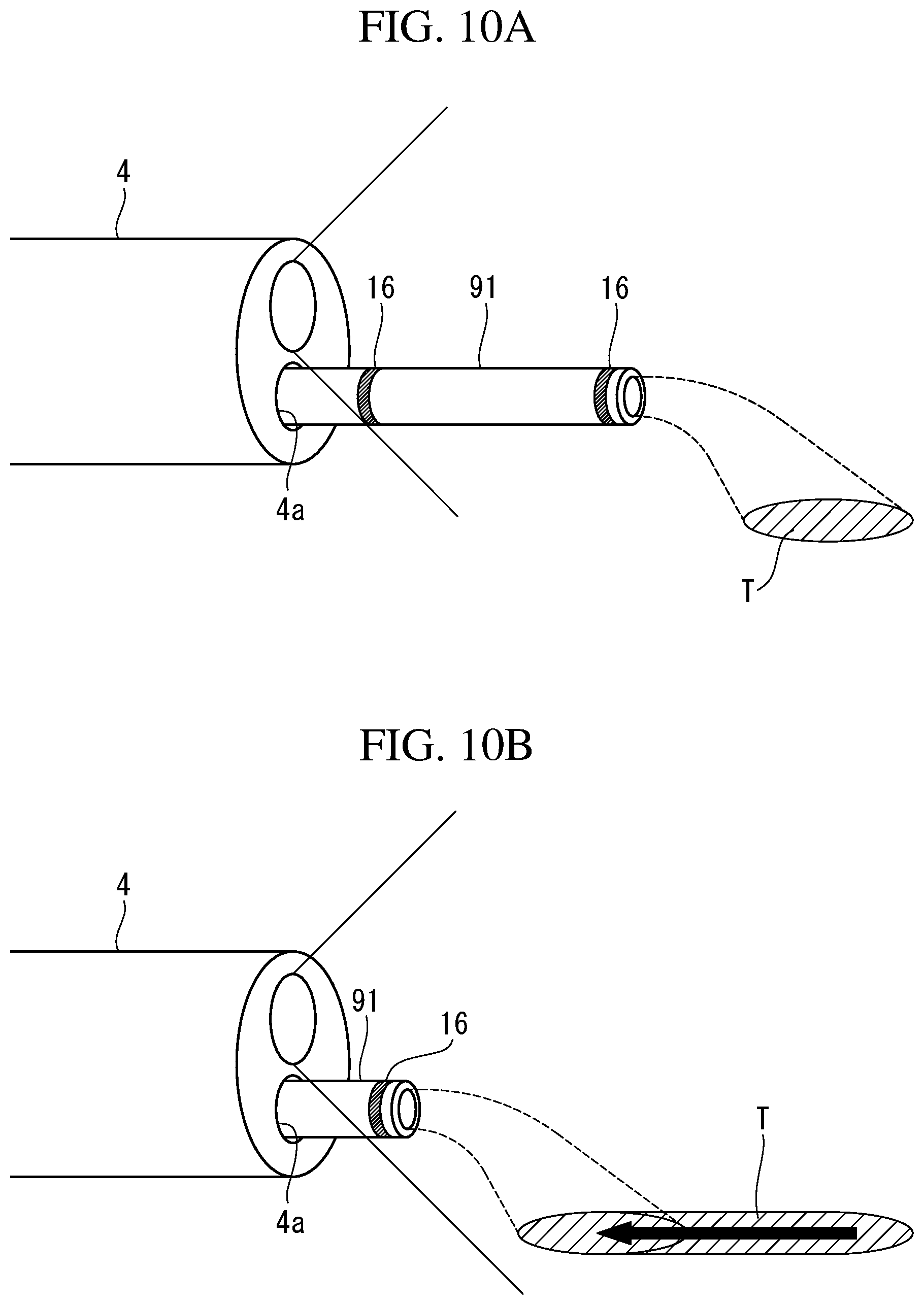 Patent US12102306 Figure 11 – Ablation-treatment-tool control device, ablation system, and ileal-mucosa ablation treatment method