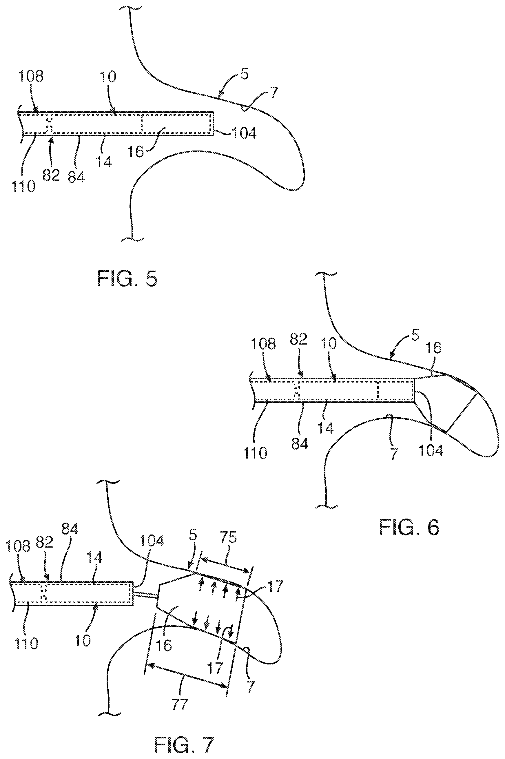 Patent US12102309 Figure 4 – Medical device and system for occluding a tissue opening and method thereof