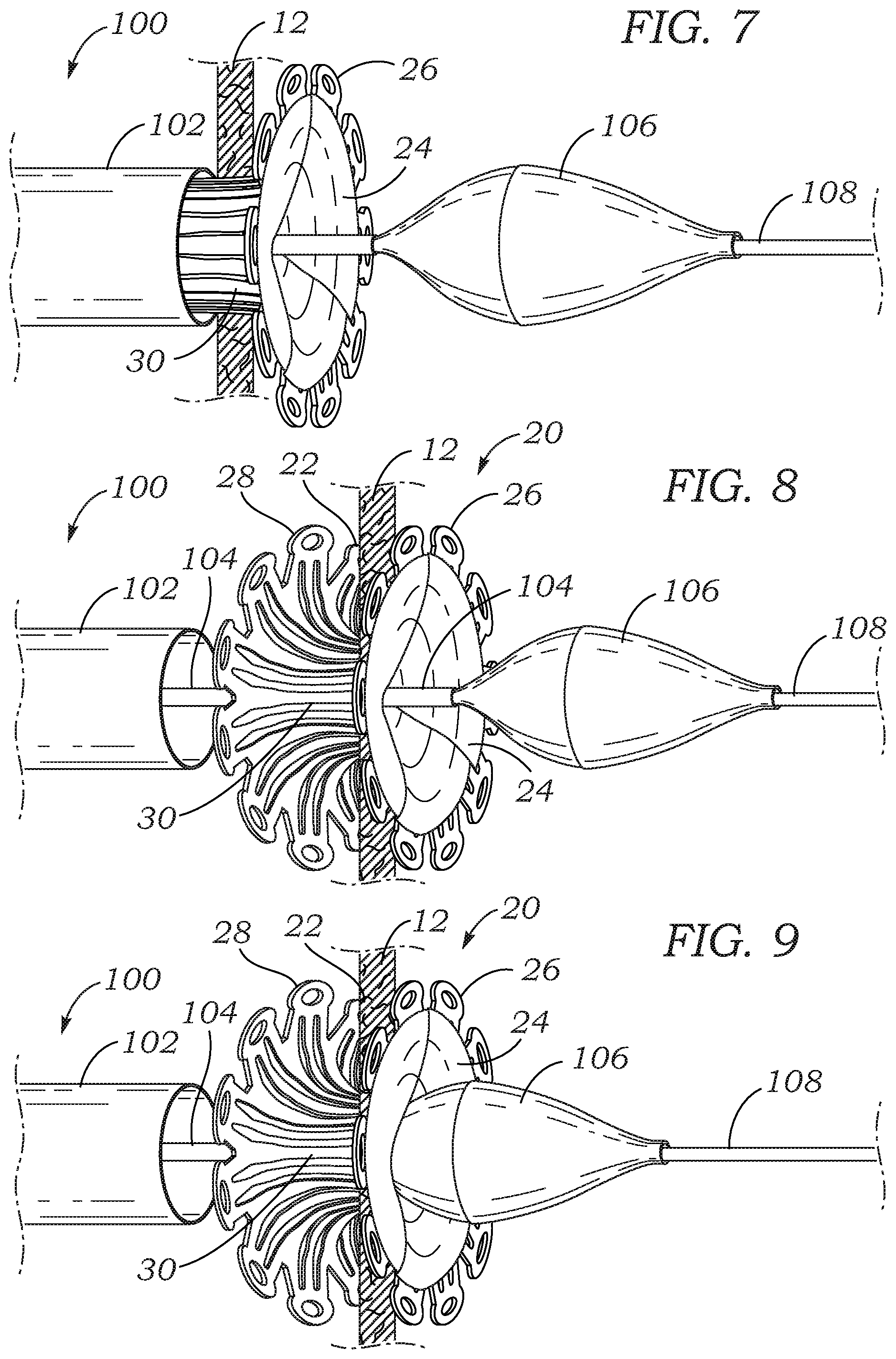 Patent US12102310 Figure 3 – Trans-septal closure and port device