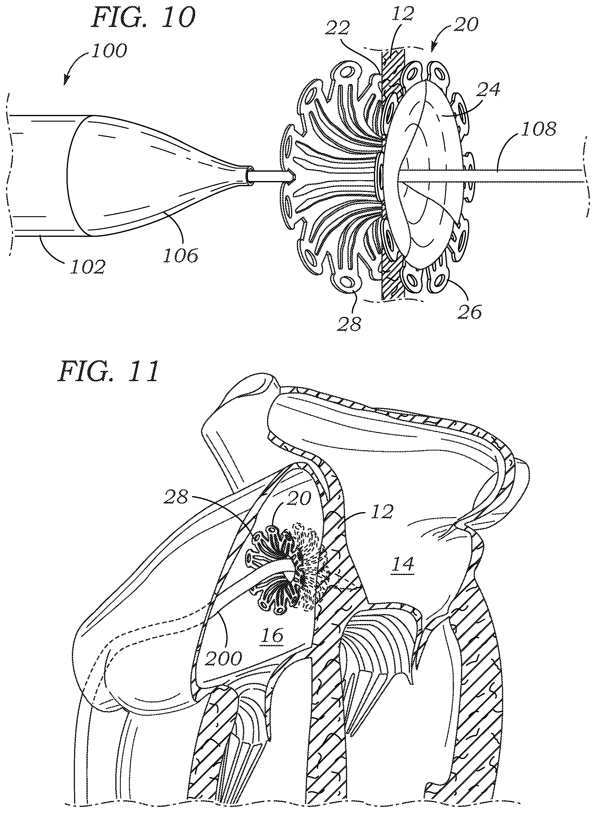 Patent US12102310 Figure 4 – Trans-septal closure and port device