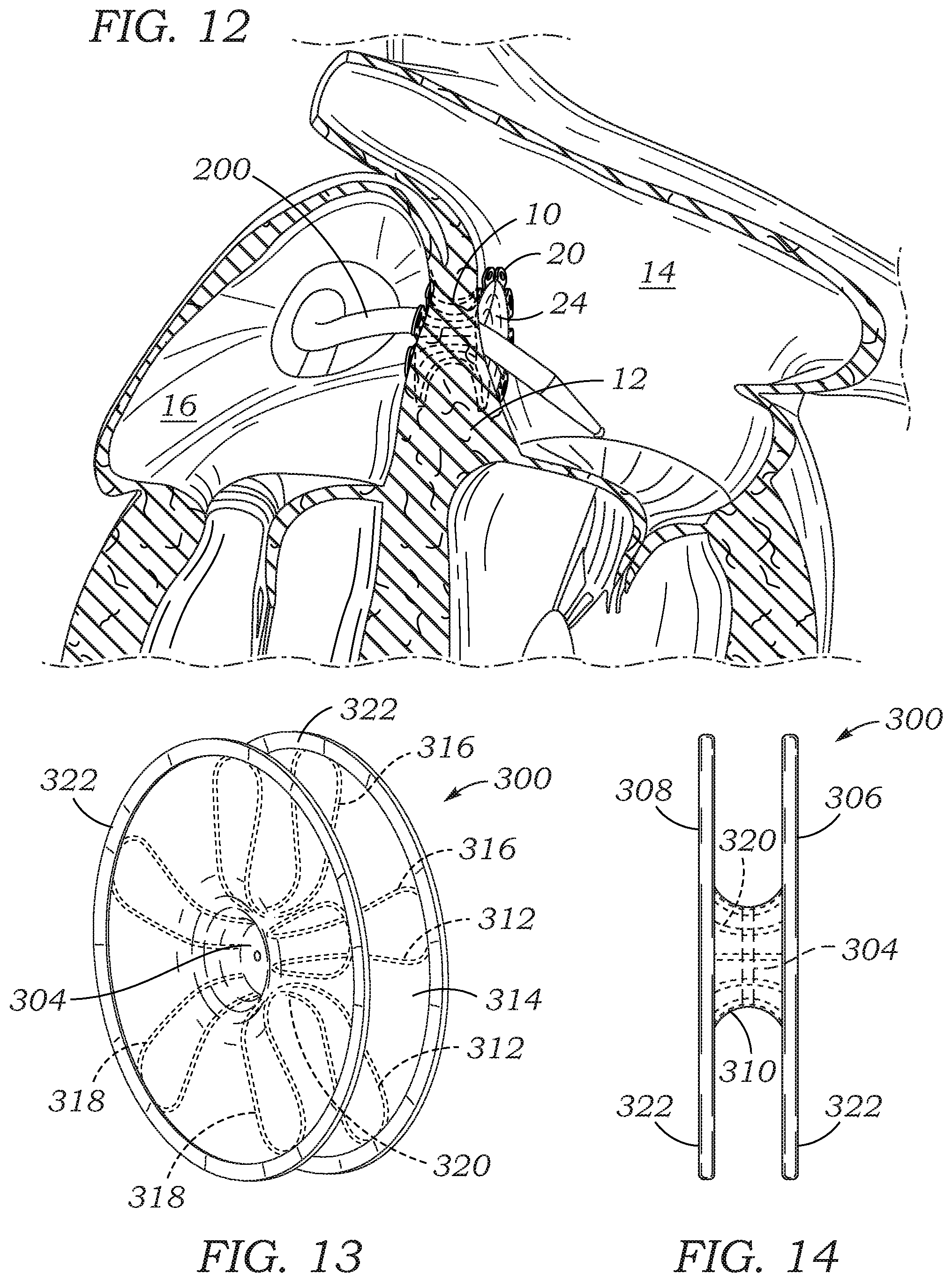 Patent US12102310 Figure 5 – Trans-septal closure and port device