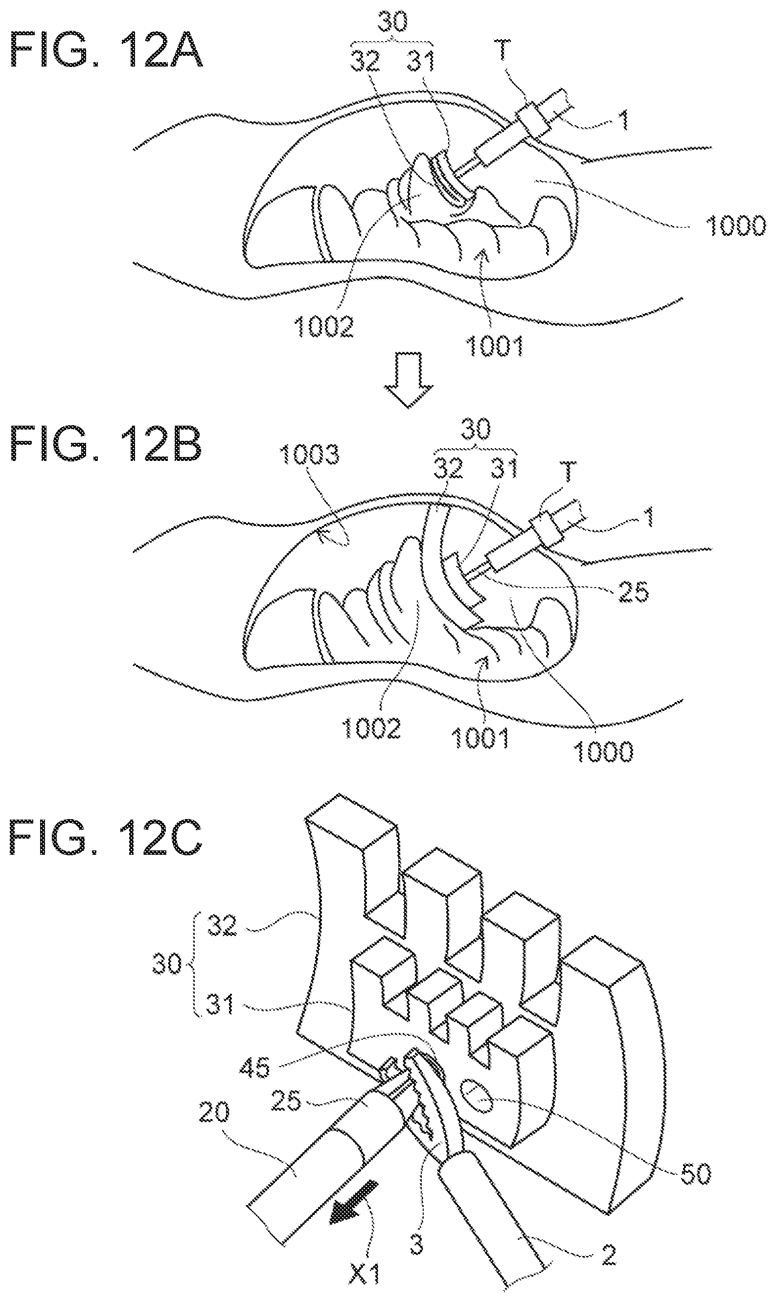 Patent US12102311 Figure 10 – Organ retraction device