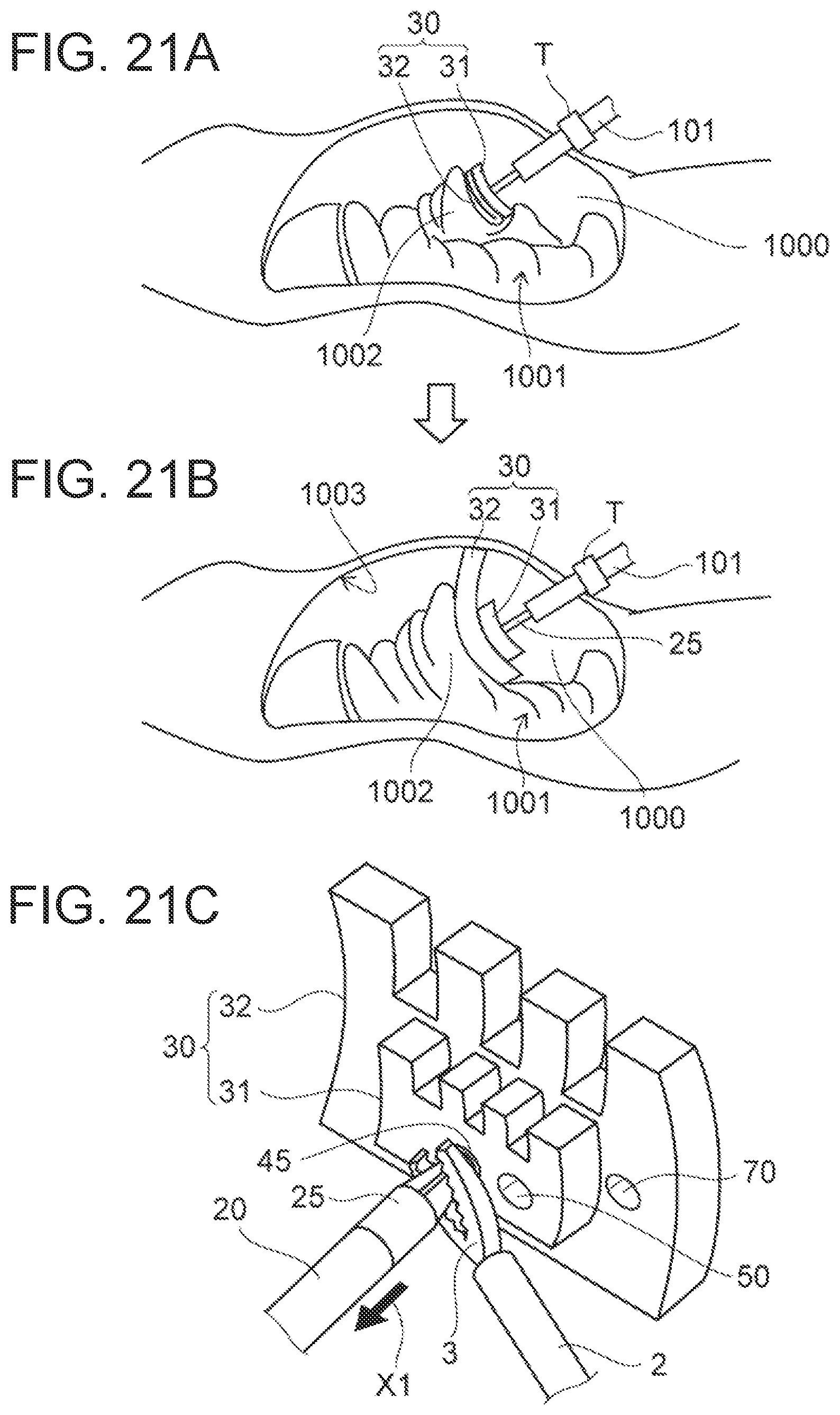 Patent US12102311 Figure 18 – Organ retraction device