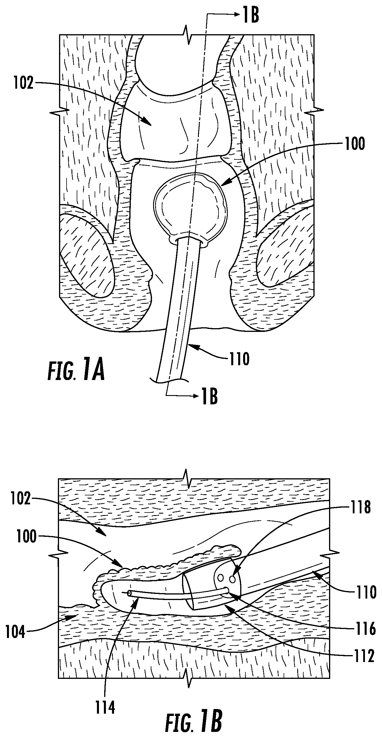 Patent US12102312 Figure 1 – Expandable devices, systems, and methods