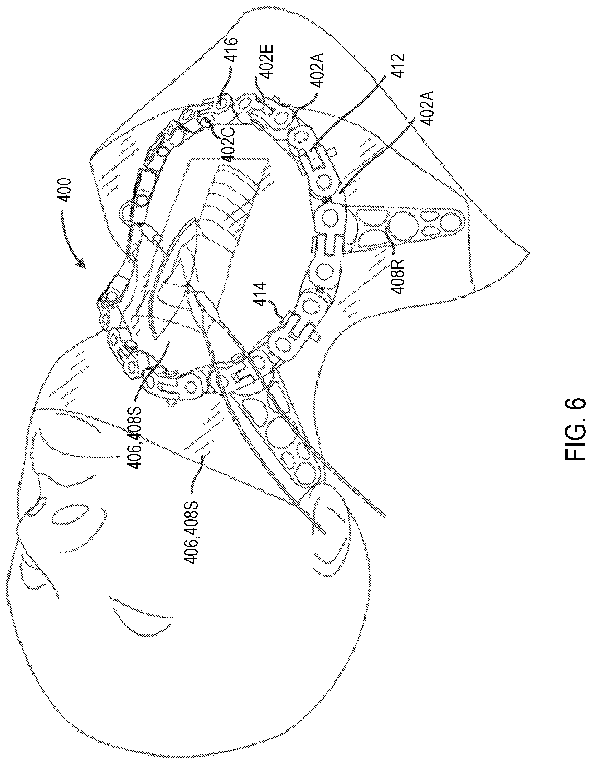 Patent US12102314 Figure 13 – Systems and methods including an adjustable retractor frame