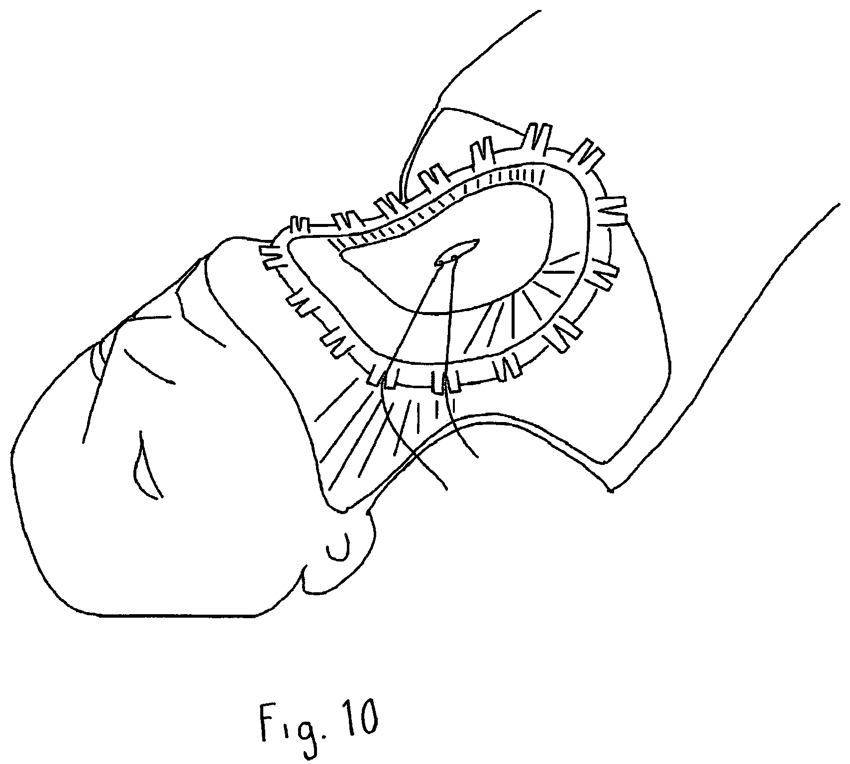 Patent US12102314 Figure 16 – Systems and methods including an adjustable retractor frame