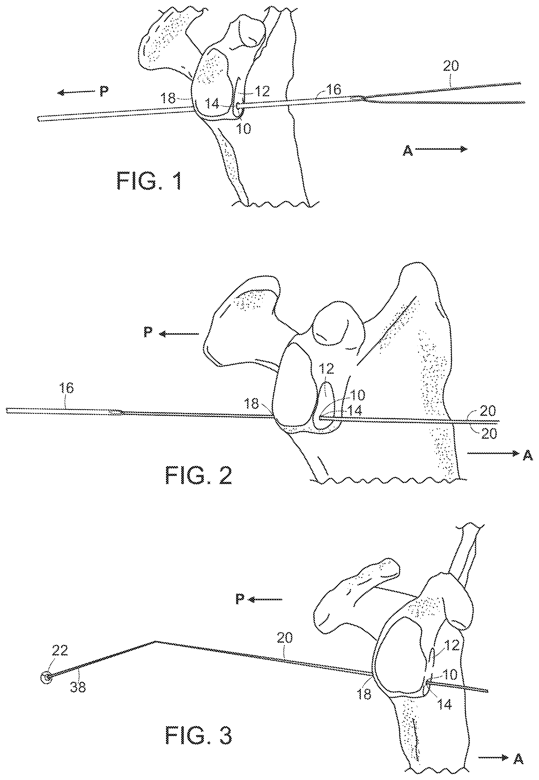 Patent US12102315 Figure 1 – Methods for passing a posterior button suture for medical procedures