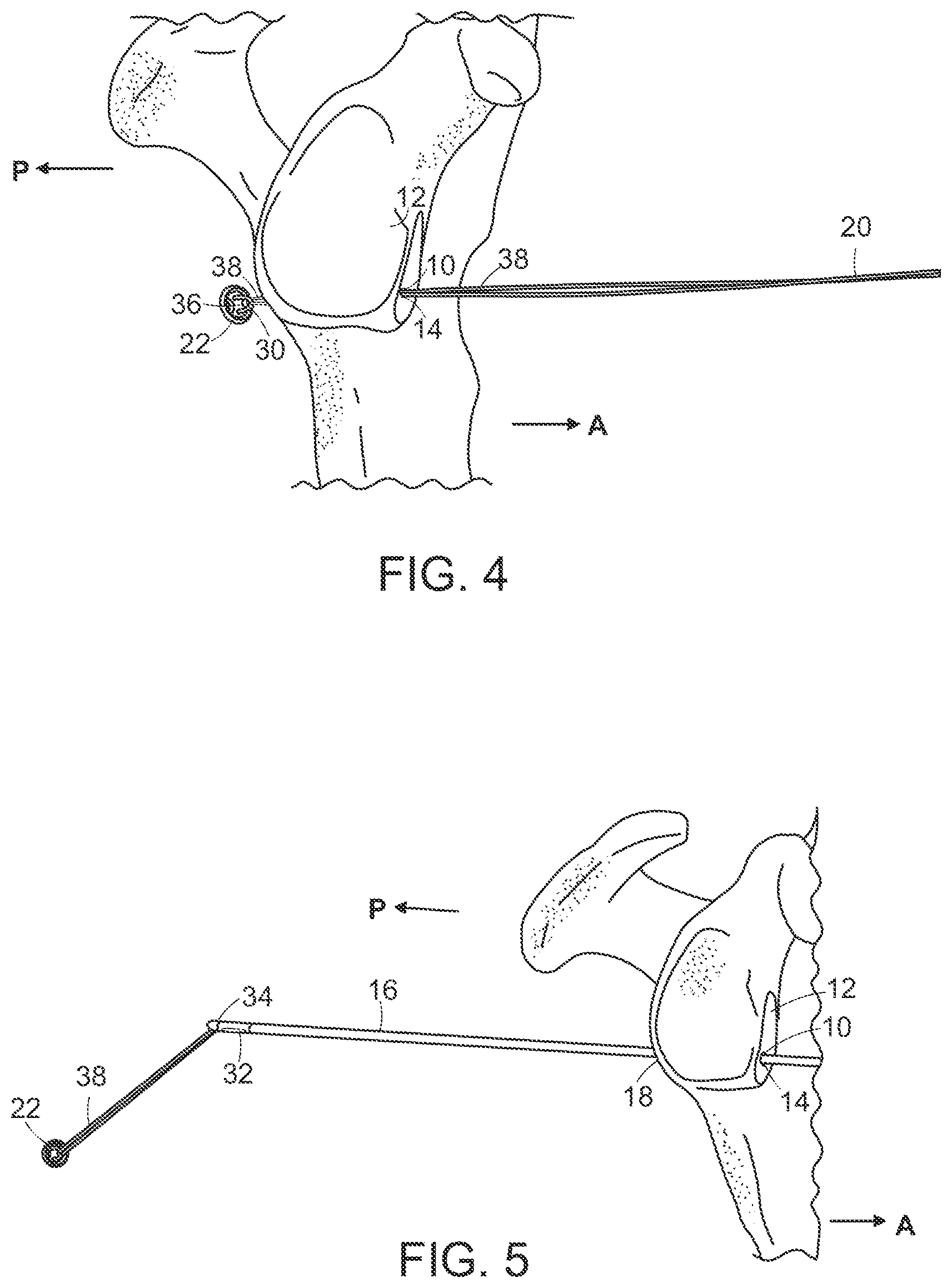Patent US12102315 Figure 2 – Methods for passing a posterior button suture for medical procedures