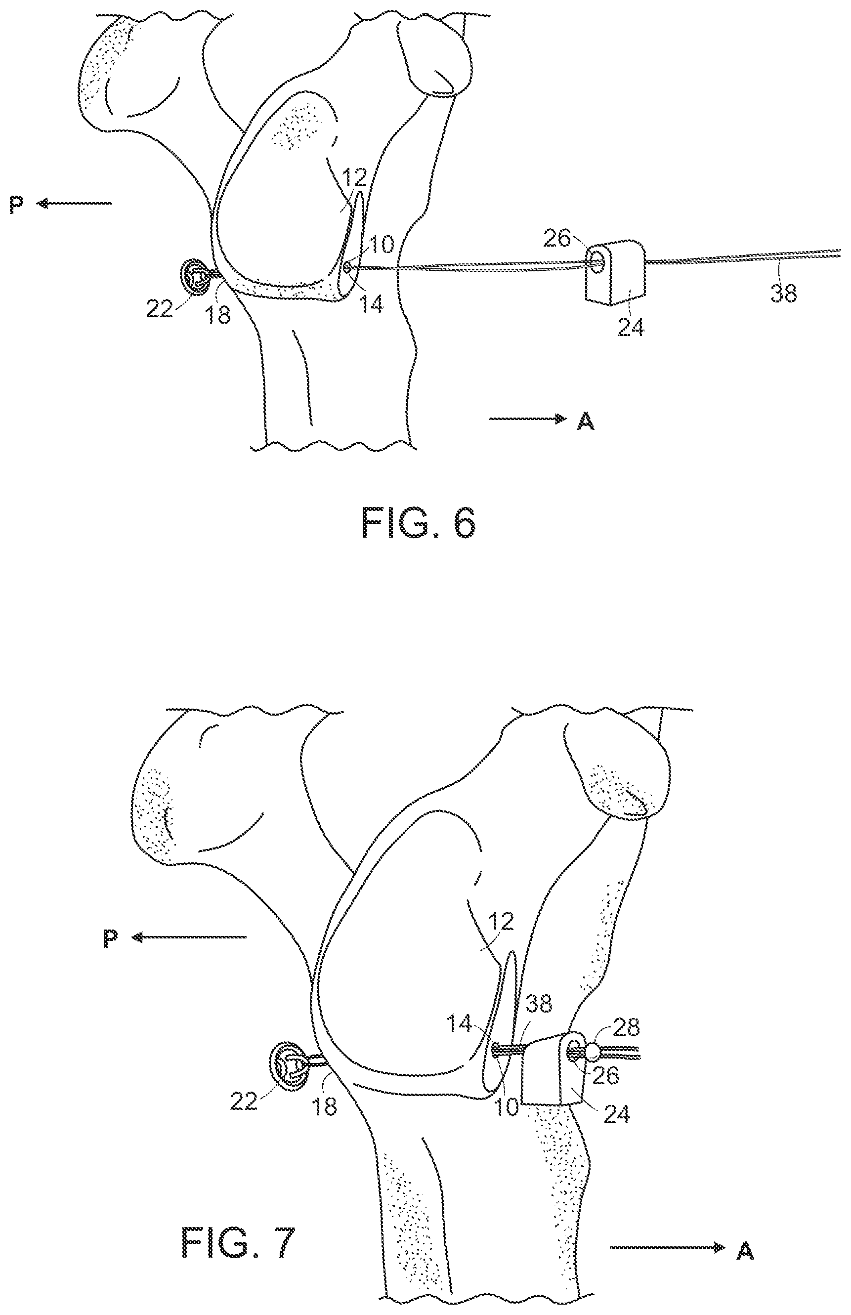 Patent US12102315 Figure 3 – Methods for passing a posterior button suture for medical procedures
