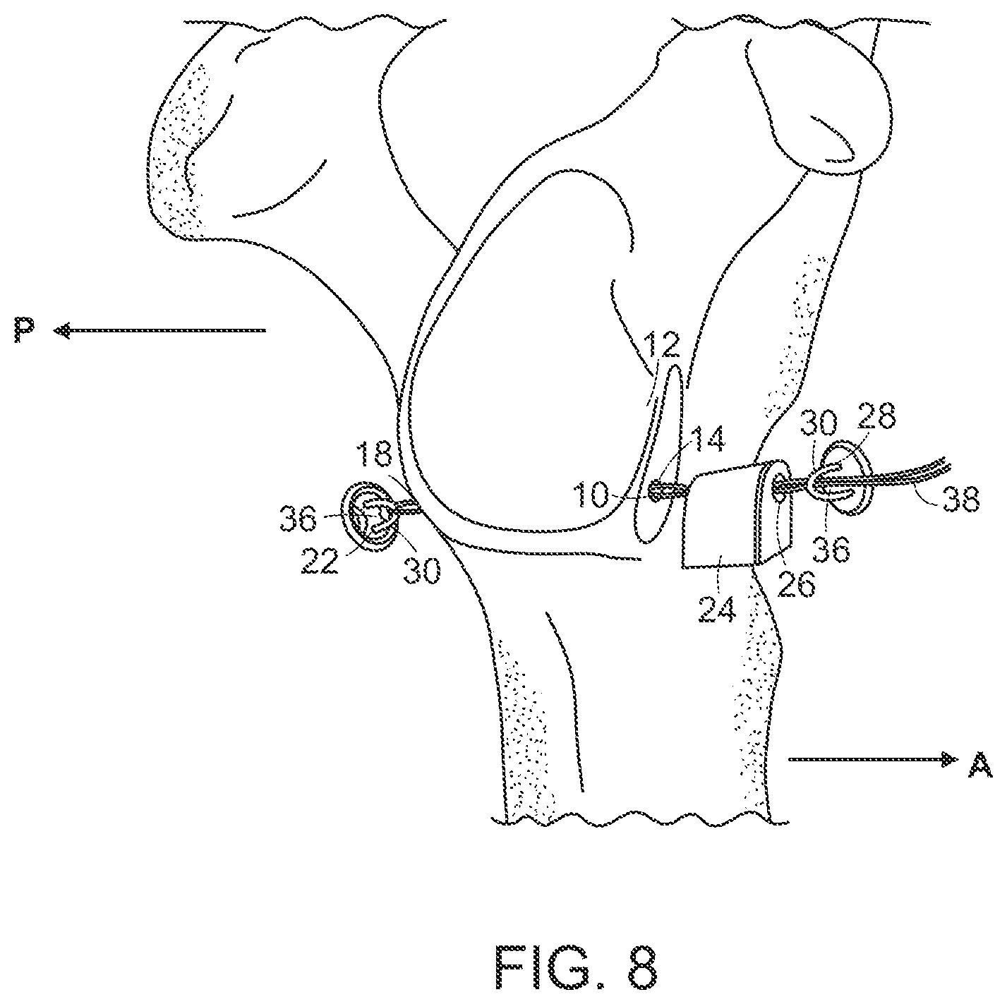 Patent US12102315 Figure 4 – Methods for passing a posterior button suture for medical procedures