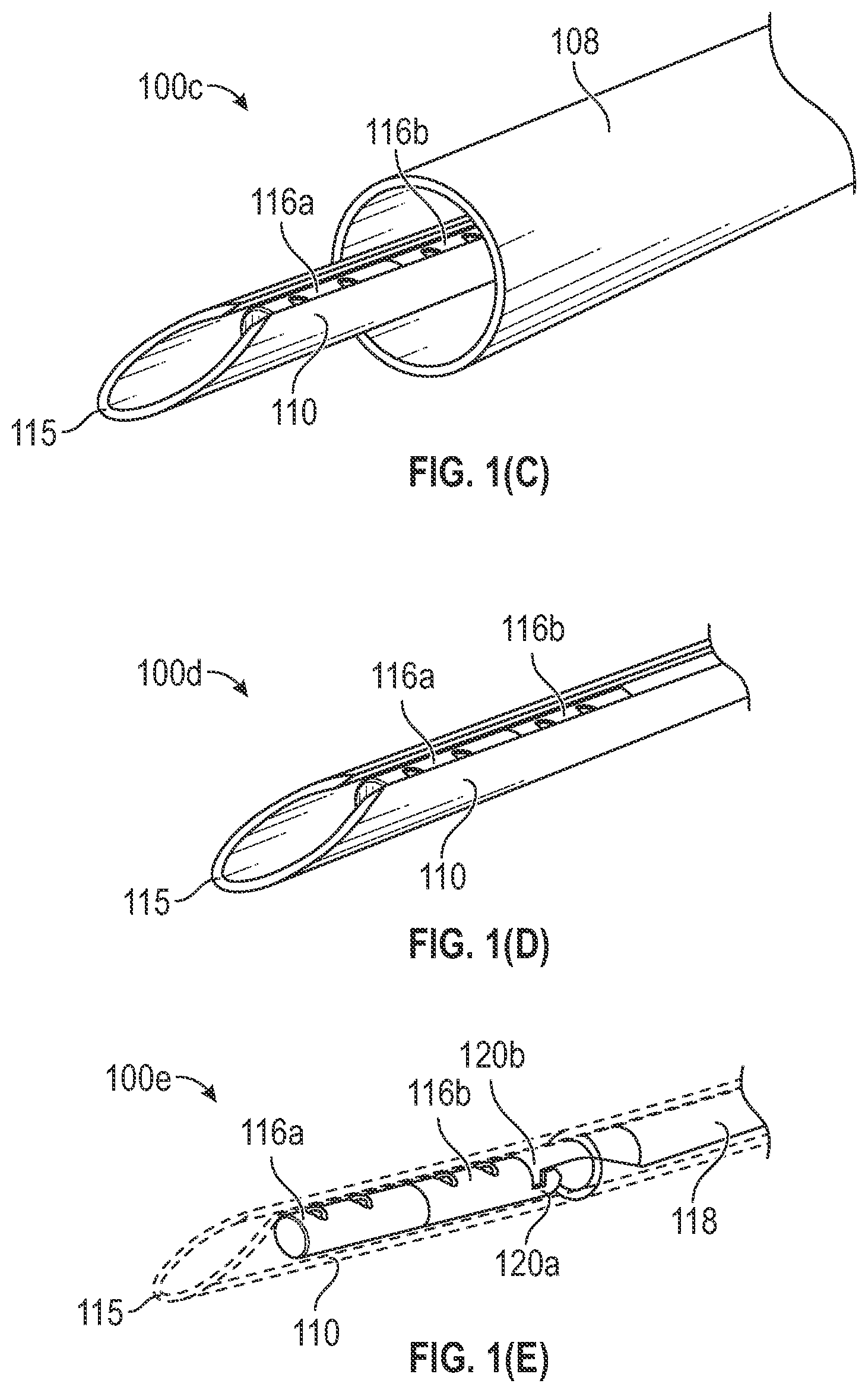 Patent US12102318 Figure 2 – Tissue repair device and method to repair tissue by deploying implants