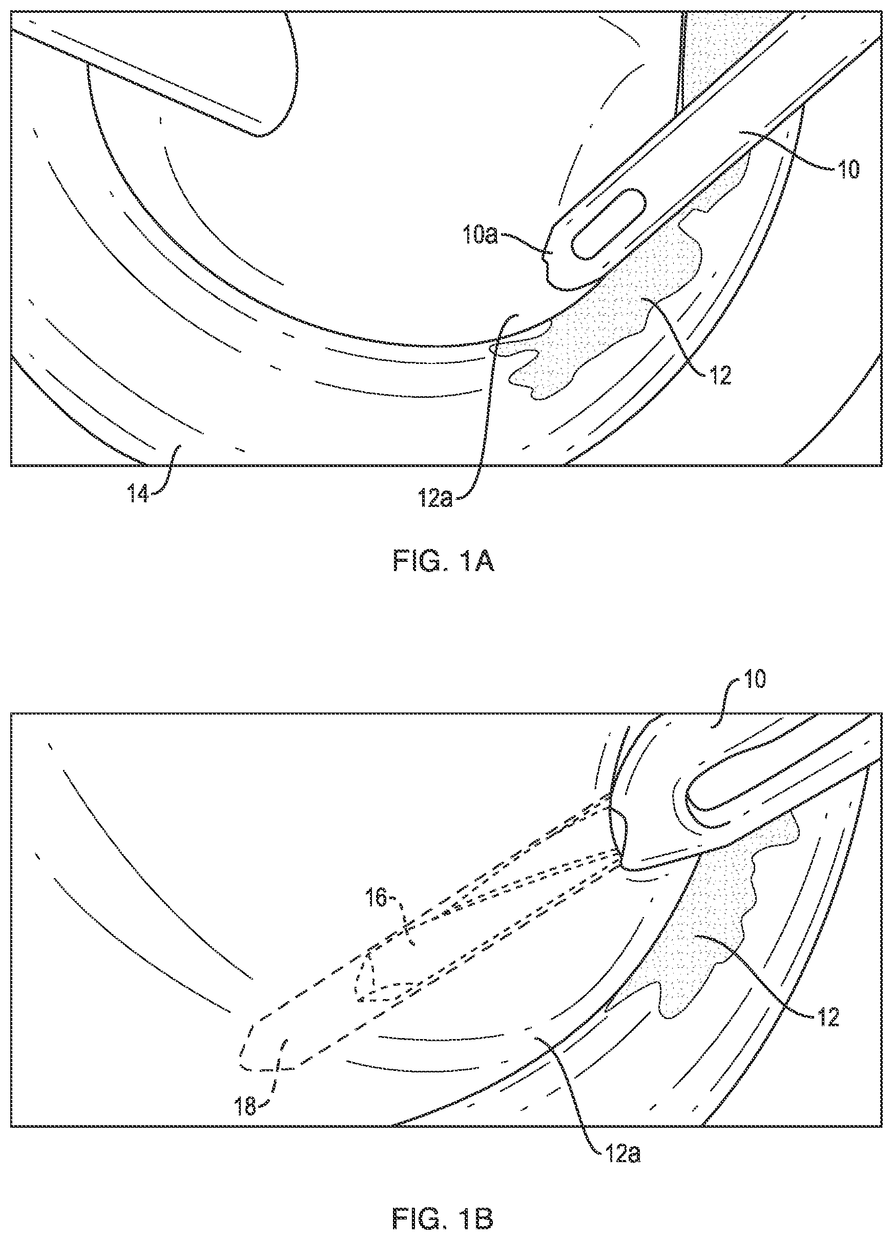 Patent US12102319 Figure 1 – Methods for measuring tissue defects