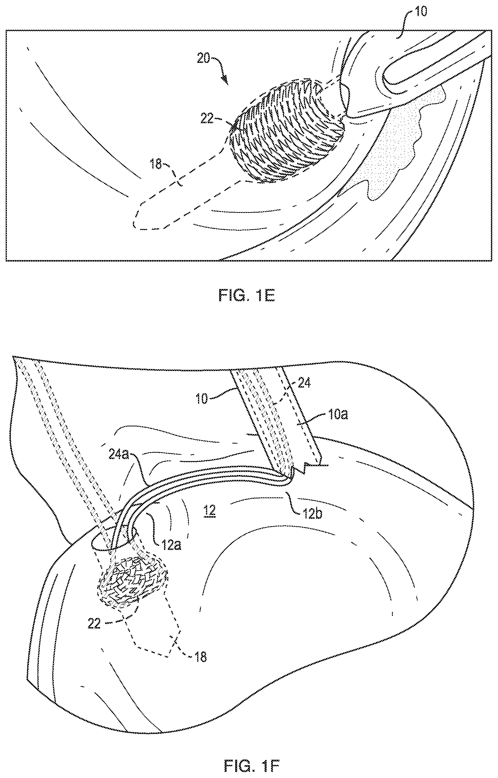 Patent US12102319 Figure 3 – Methods for measuring tissue defects