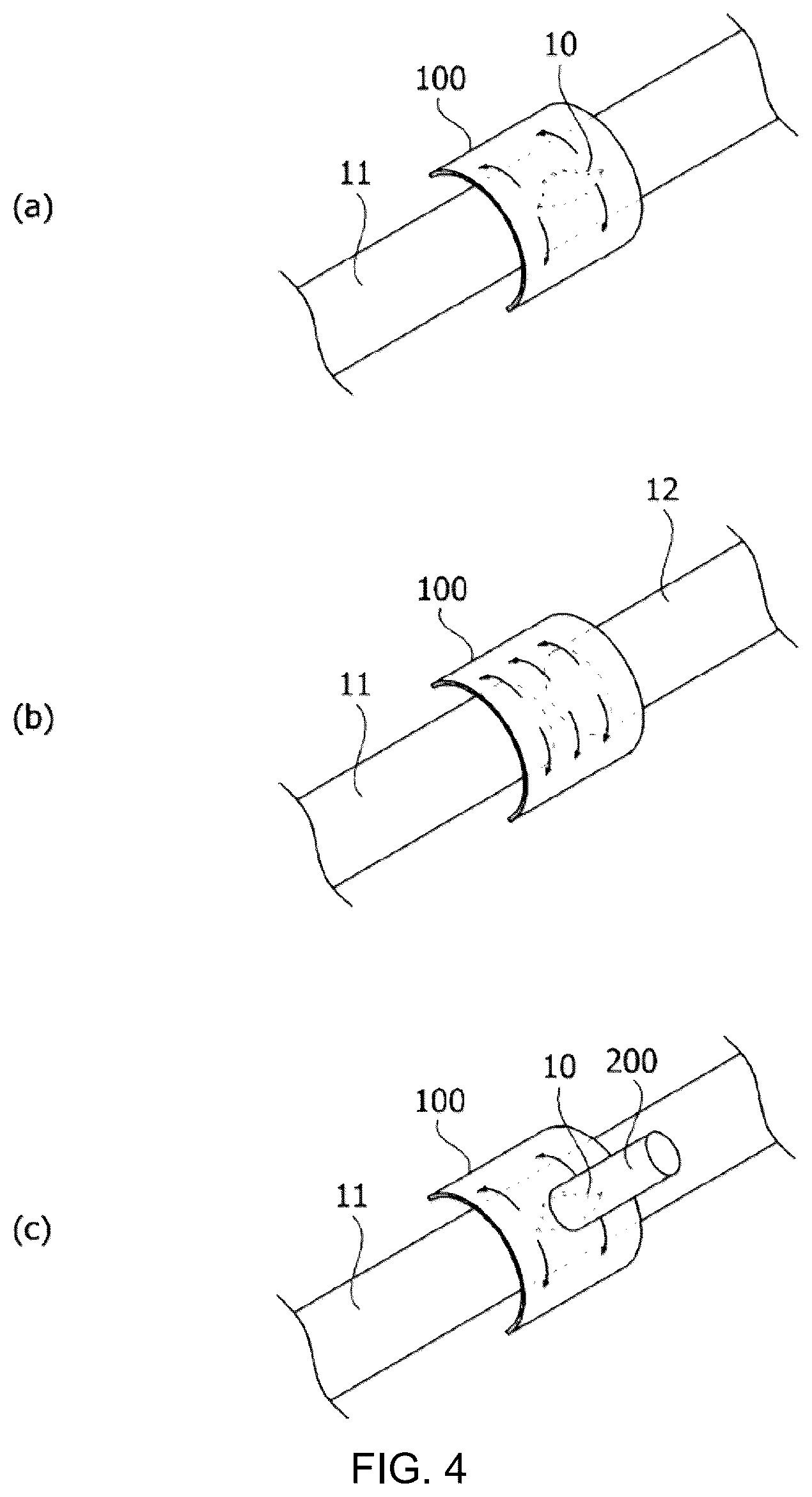 Patent US12102324 Figure 4 – Vascular anastomotic member comprising shape-memory polymer