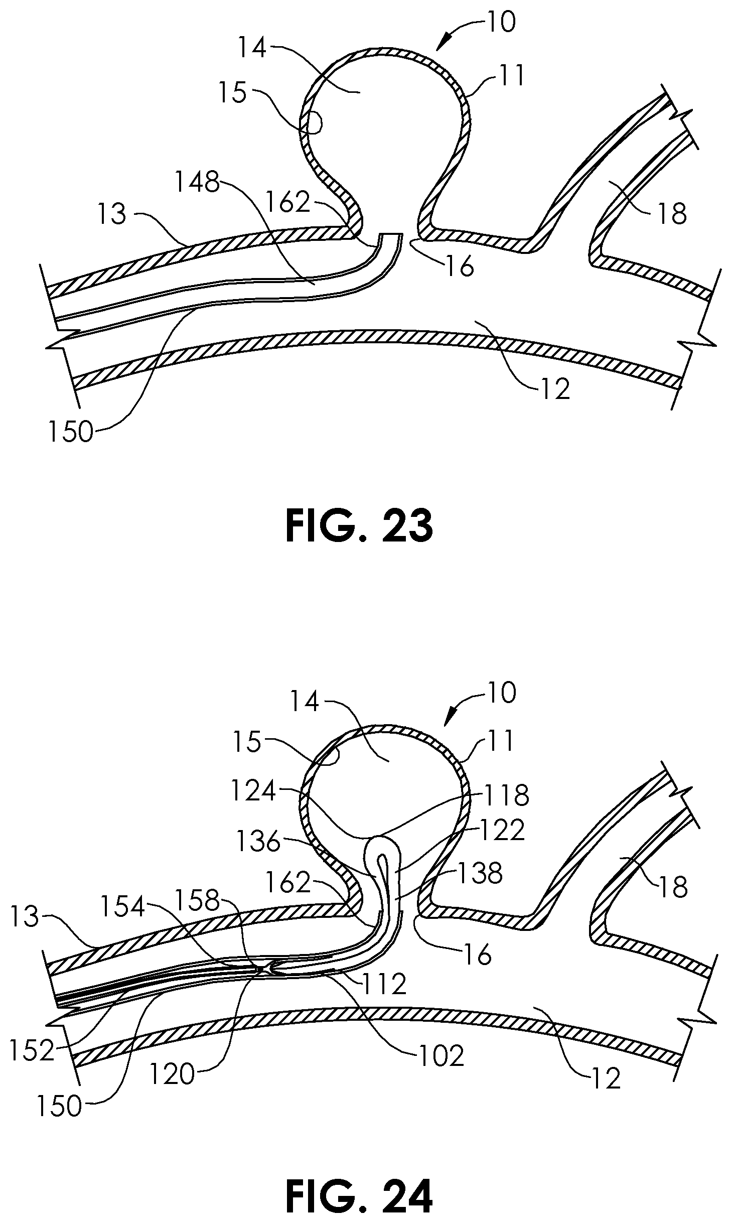 Patent US12102327 Figure 11 – Systems and methods for treating aneurysms