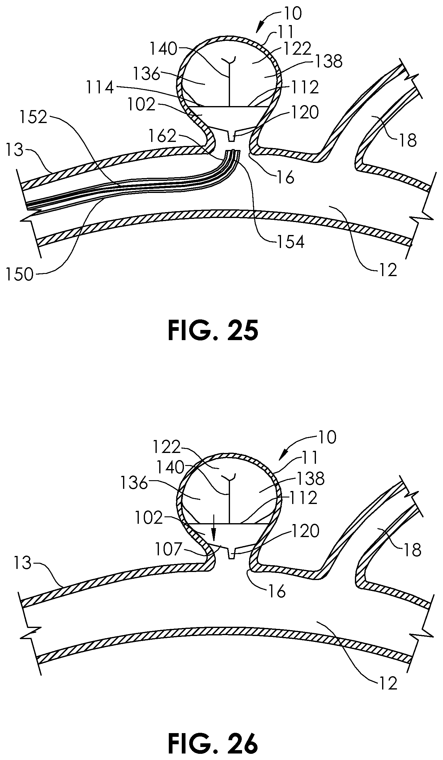 Patent US12102327 Figure 12 – Systems and methods for treating aneurysms