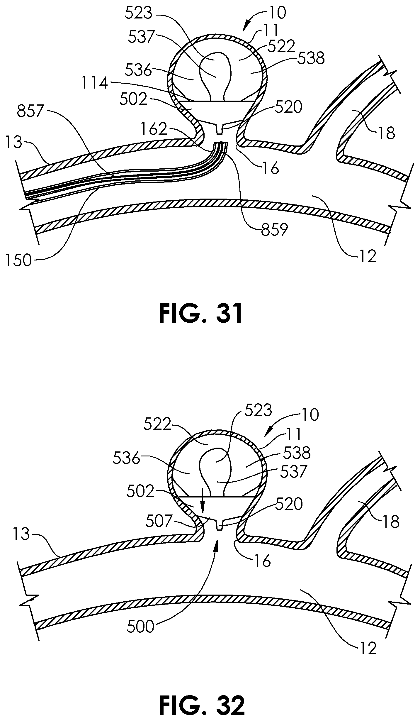 Patent US12102327 Figure 15 – Systems and methods for treating aneurysms