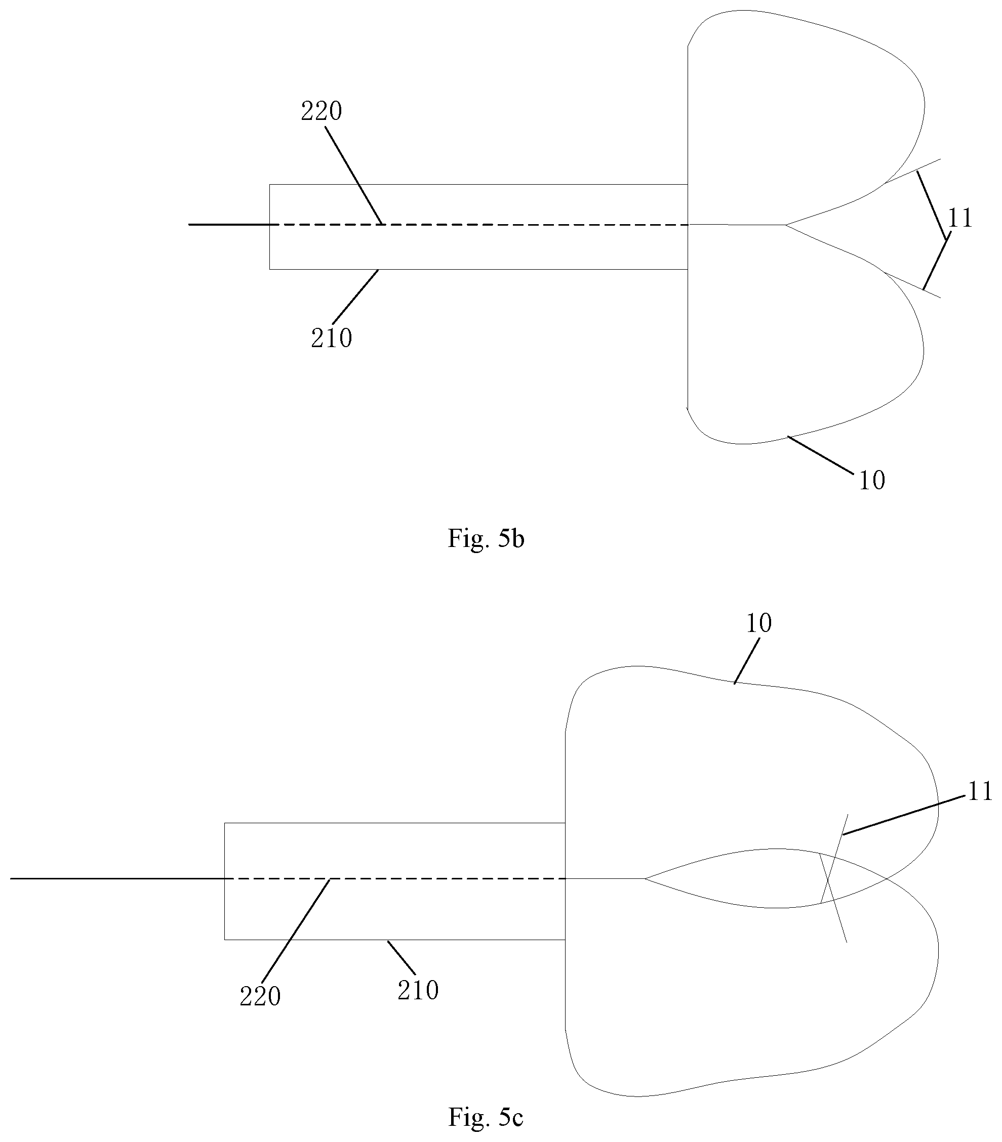 Patent US12102328 Figure 5 – Left atrial appendage occluder and left atrial appendage occlusion system