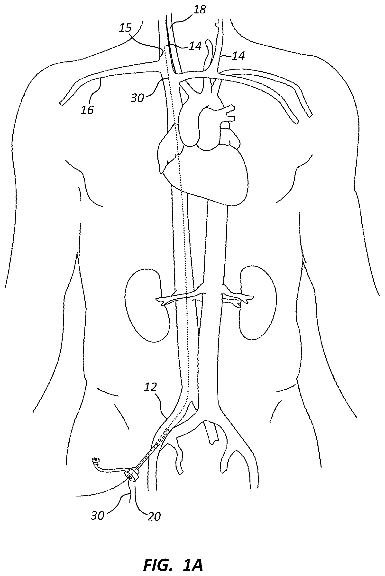 Patent US12102329 Figure 1 – Carotid artery embolic protection method using percutaneous transjugular carotid flow reversal