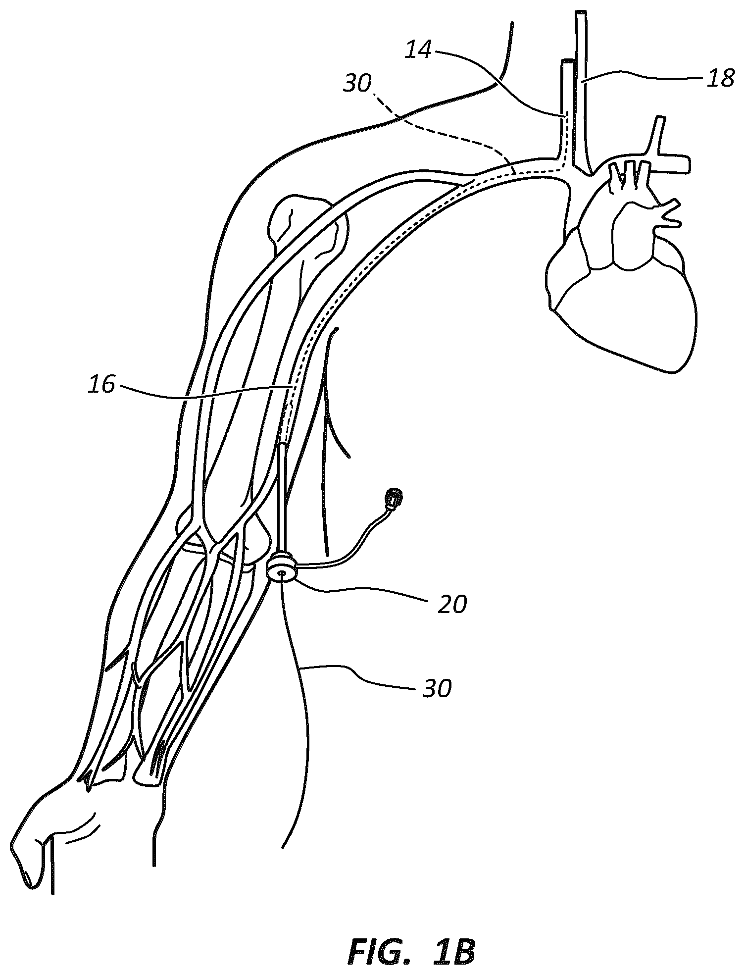 Patent US12102329 Figure 2 – Carotid artery embolic protection method using percutaneous transjugular carotid flow reversal