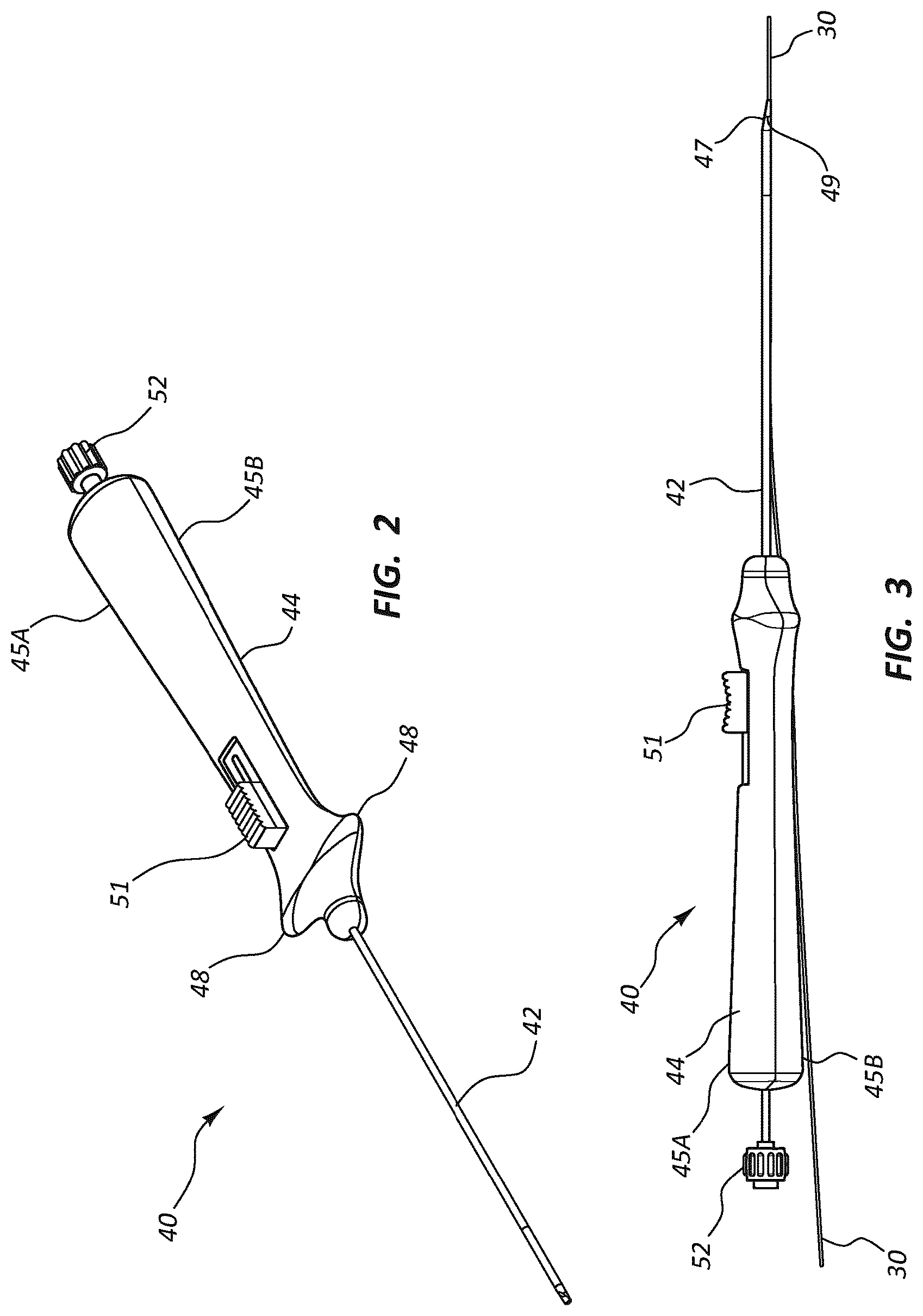 Patent US12102329 Figure 3 – Carotid artery embolic protection method using percutaneous transjugular carotid flow reversal