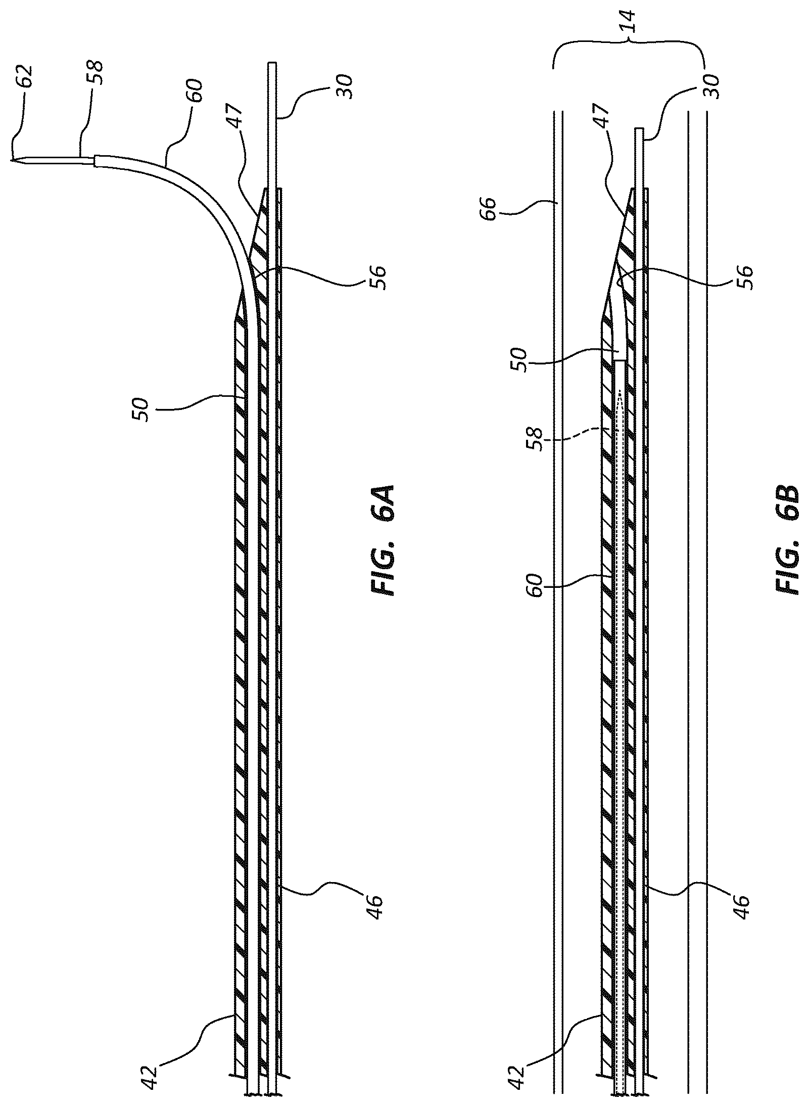 Patent US12102329 Figure 8 – Carotid artery embolic protection method using percutaneous transjugular carotid flow reversal