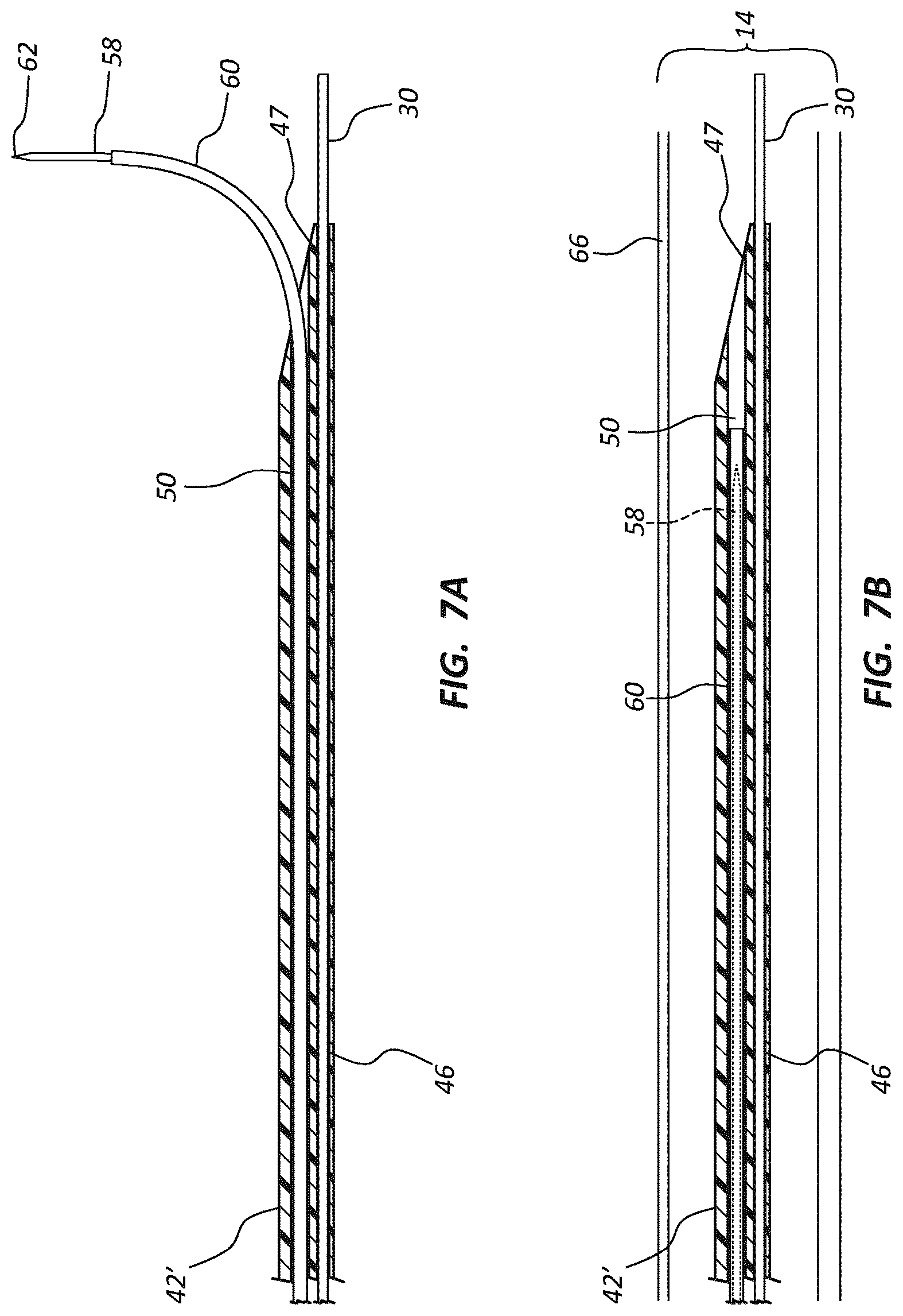 Patent US12102329 Figure 9 – Carotid artery embolic protection method using percutaneous transjugular carotid flow reversal