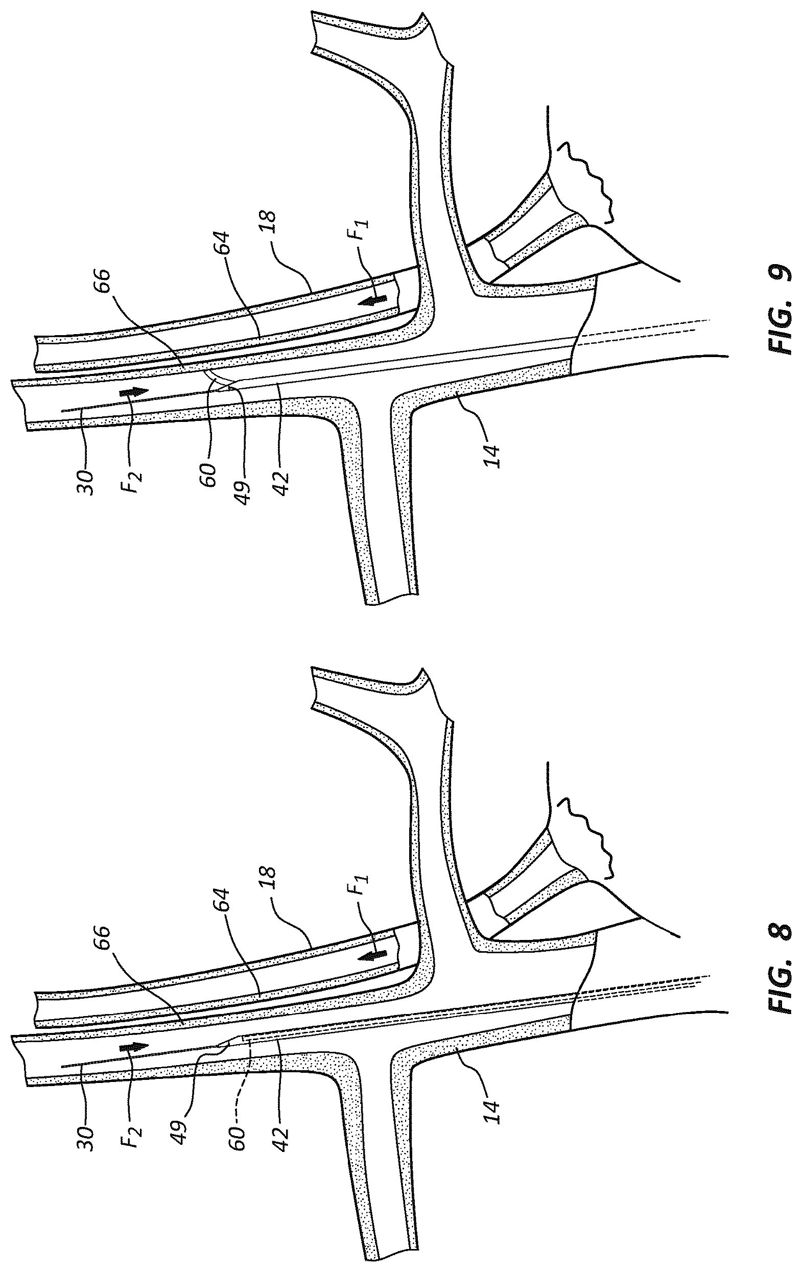 Patent US12102329 Figure 10 – Carotid artery embolic protection method using percutaneous transjugular carotid flow reversal