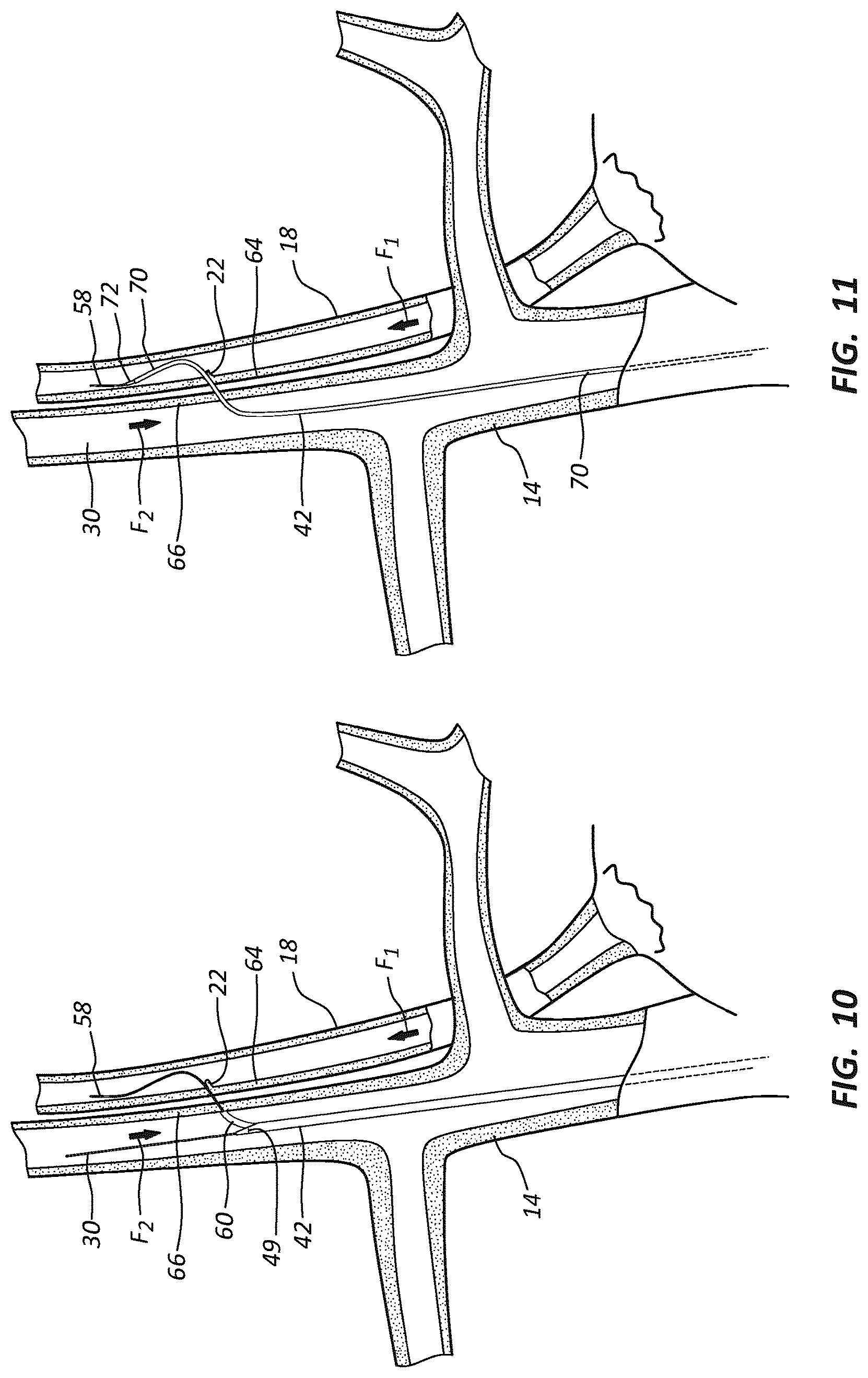 Patent US12102329 Figure 11 – Carotid artery embolic protection method using percutaneous transjugular carotid flow reversal
