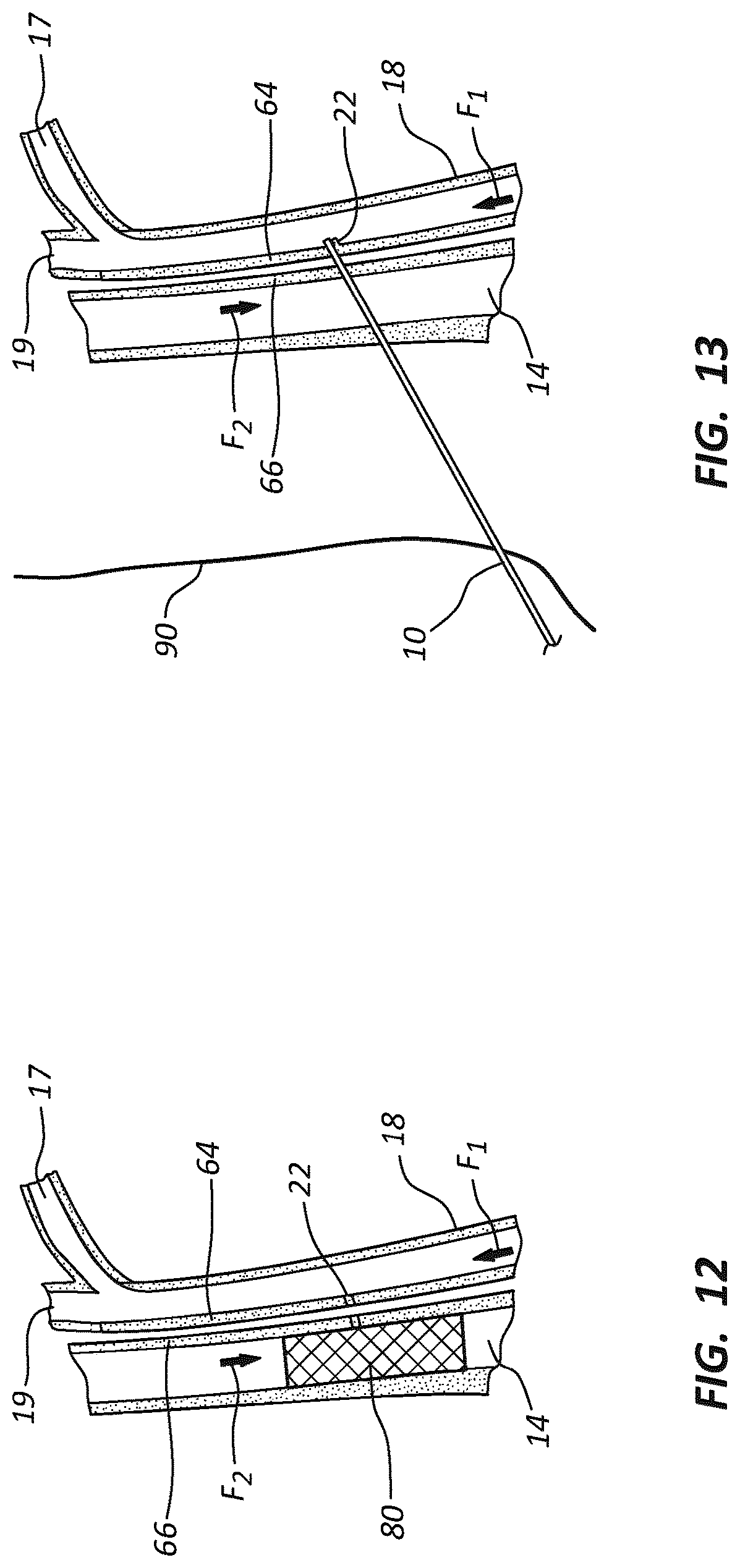 Patent US12102329 Figure 12 – Carotid artery embolic protection method using percutaneous transjugular carotid flow reversal