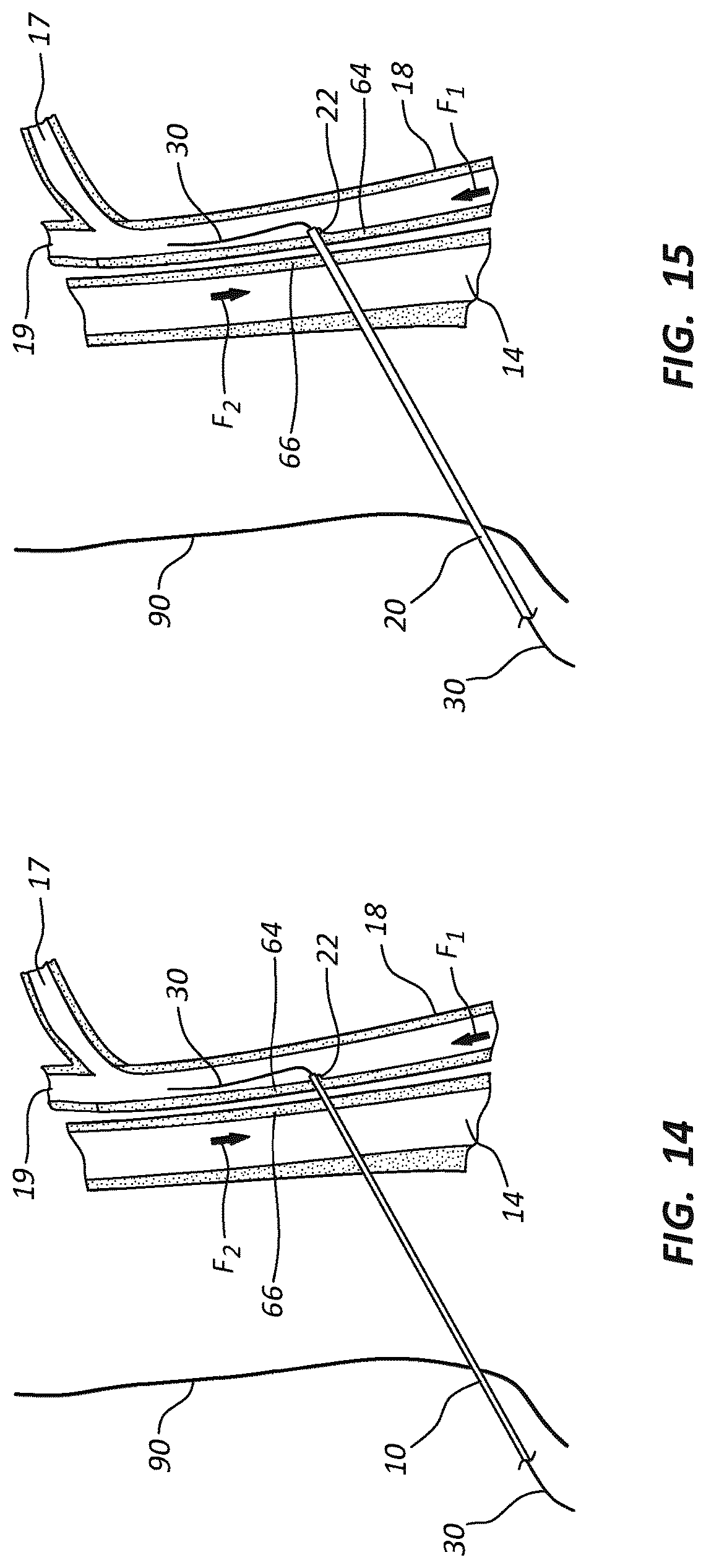 Patent US12102329 Figure 13 – Carotid artery embolic protection method using percutaneous transjugular carotid flow reversal