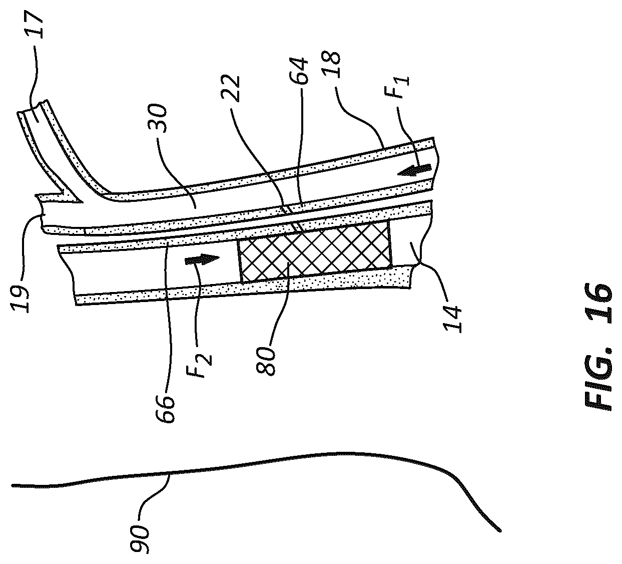 Patent US12102329 Figure 14 – Carotid artery embolic protection method using percutaneous transjugular carotid flow reversal