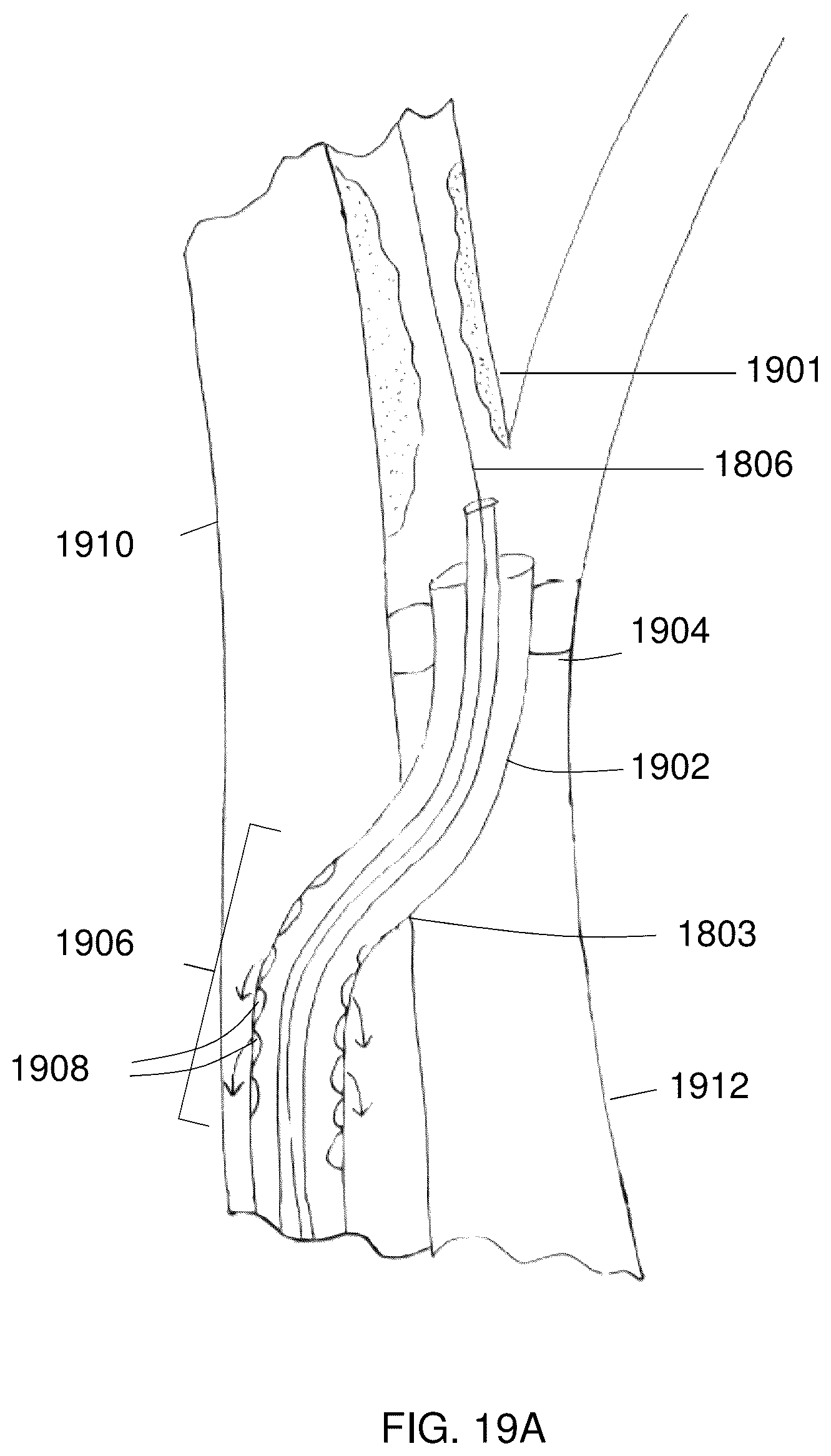 Patent US12102329 Figure 17 – Carotid artery embolic protection method using percutaneous transjugular carotid flow reversal