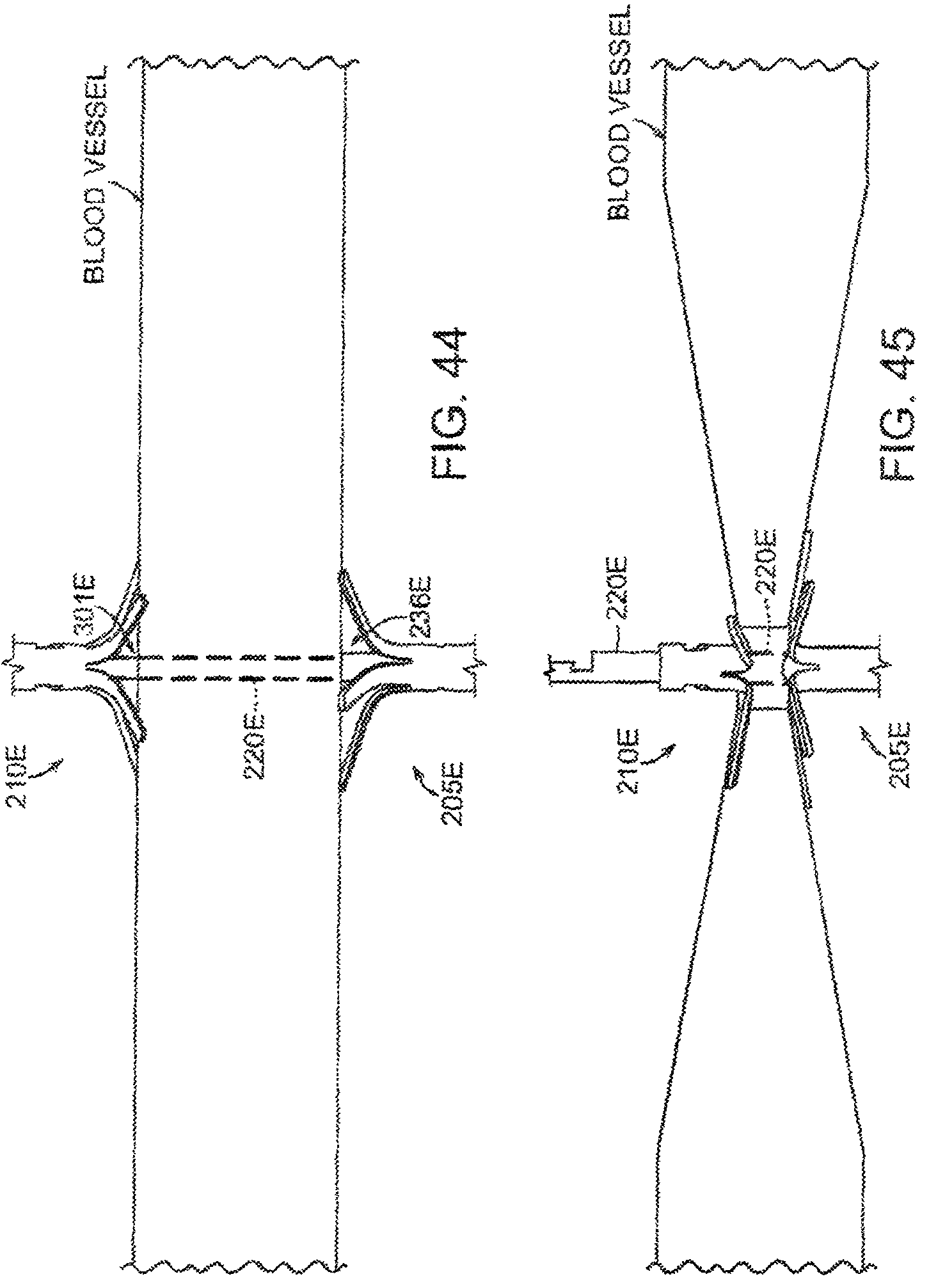 Patent US12102332 Figure 20 – Methods and apparatus for clamping tissue and occluding tubular anatomical structures