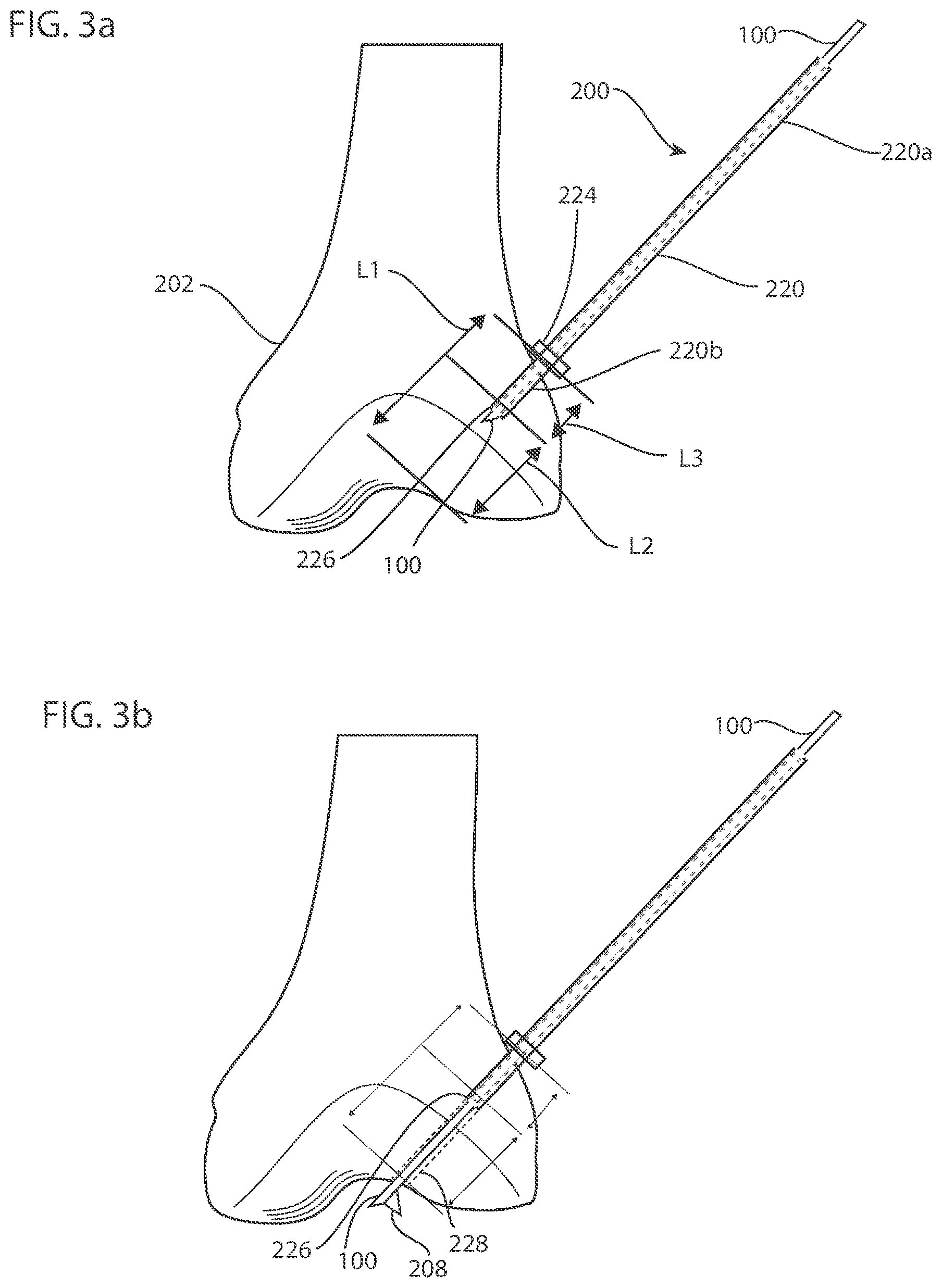 Patent US12102338 Figure 3 – System and method for creating graft tunnels in bone
